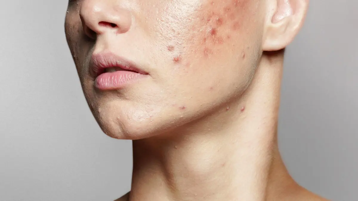 A young woman with bad skin. Skin with a lot of pimples. Acne disease, acne treatment