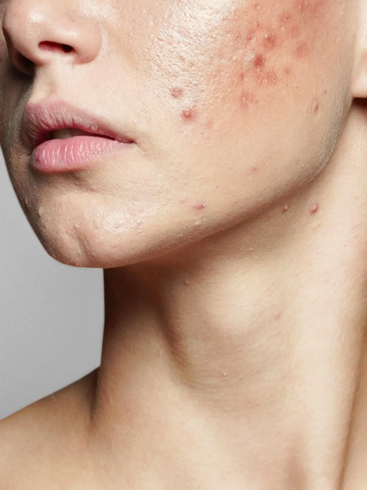 A young woman with bad skin. Skin with a lot of pimples. Acne disease, acne treatment