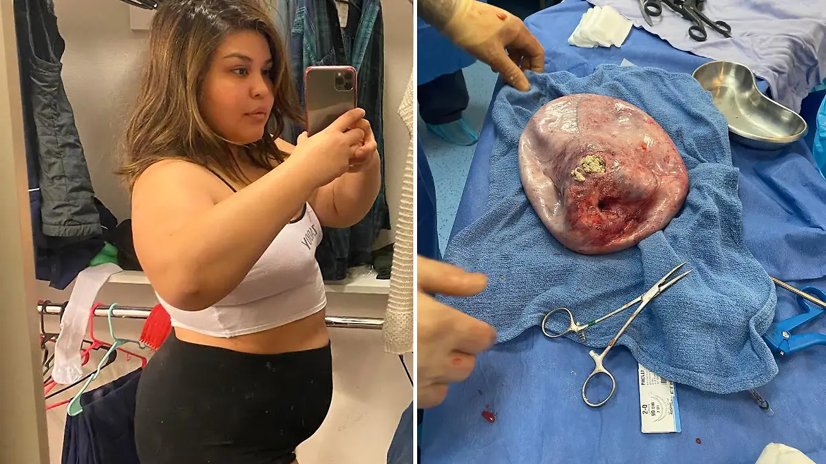 Links steht Jaimi in Unterwäsche und macht ein Selfie. Rechts ist der Tumor, der über Jahre in ihr wuchs.