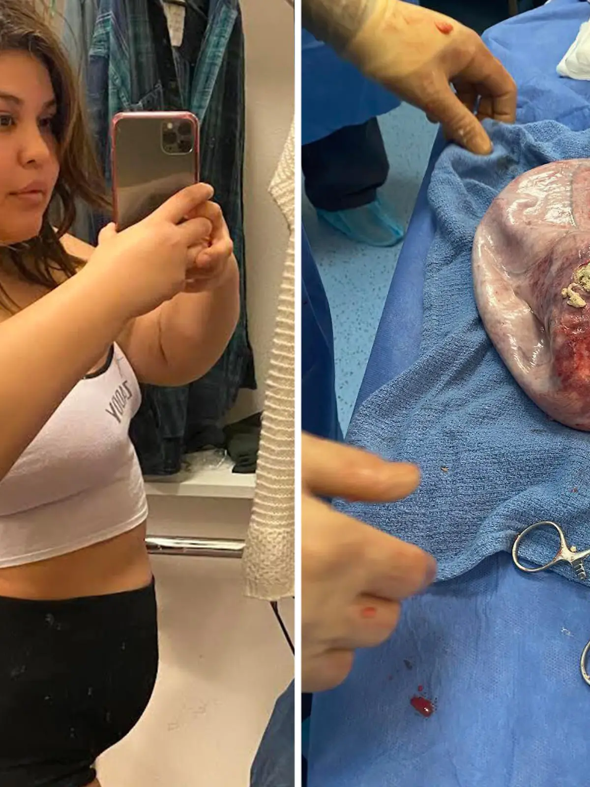 Links steht Jaimi in Unterwäsche und macht ein Selfie. Rechts ist der Tumor, der über Jahre in ihr wuchs.