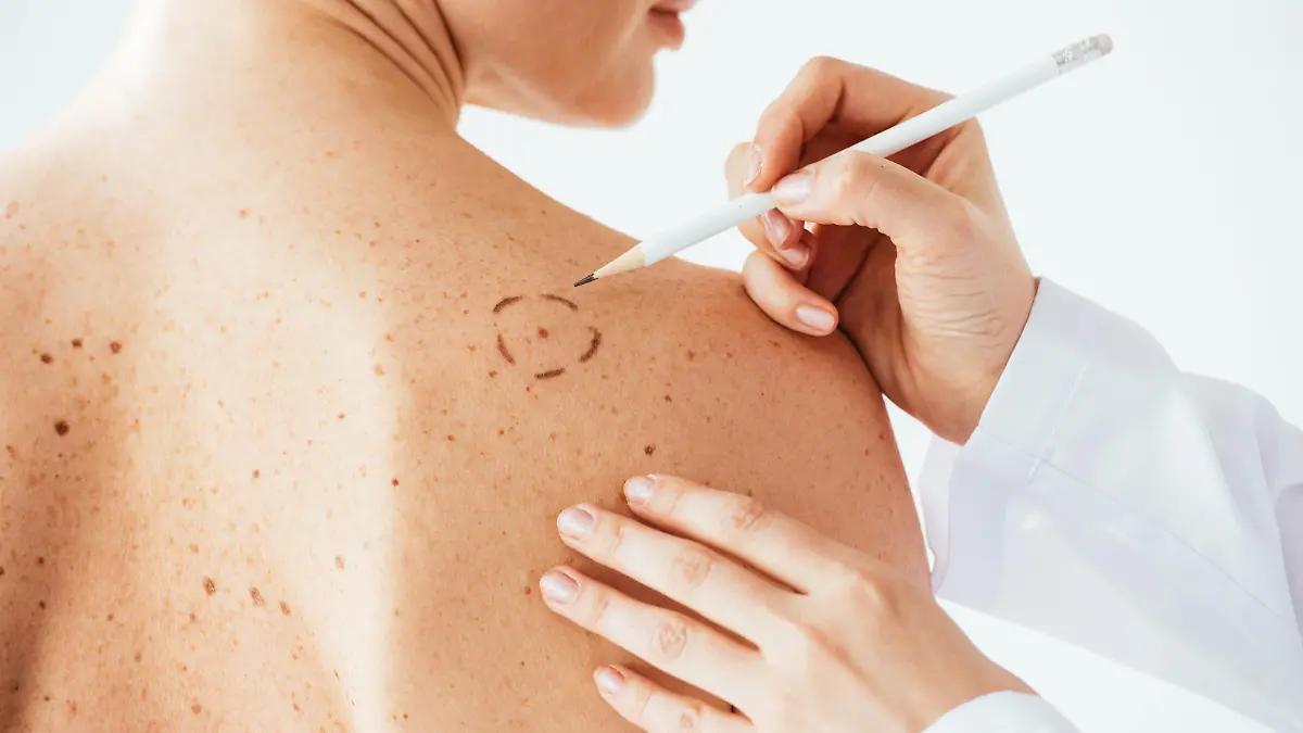 Ein Dermatologe (Hautarzt) checkt die Muttermale einer Patientin.