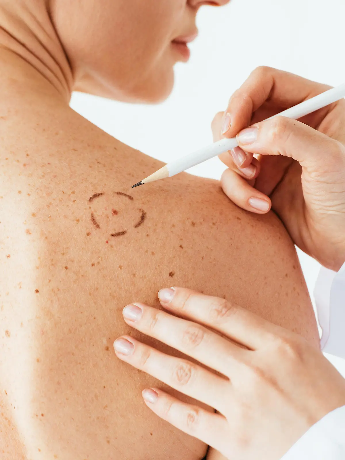 Ein Dermatologe (Hautarzt) checkt die Muttermale einer Patientin.