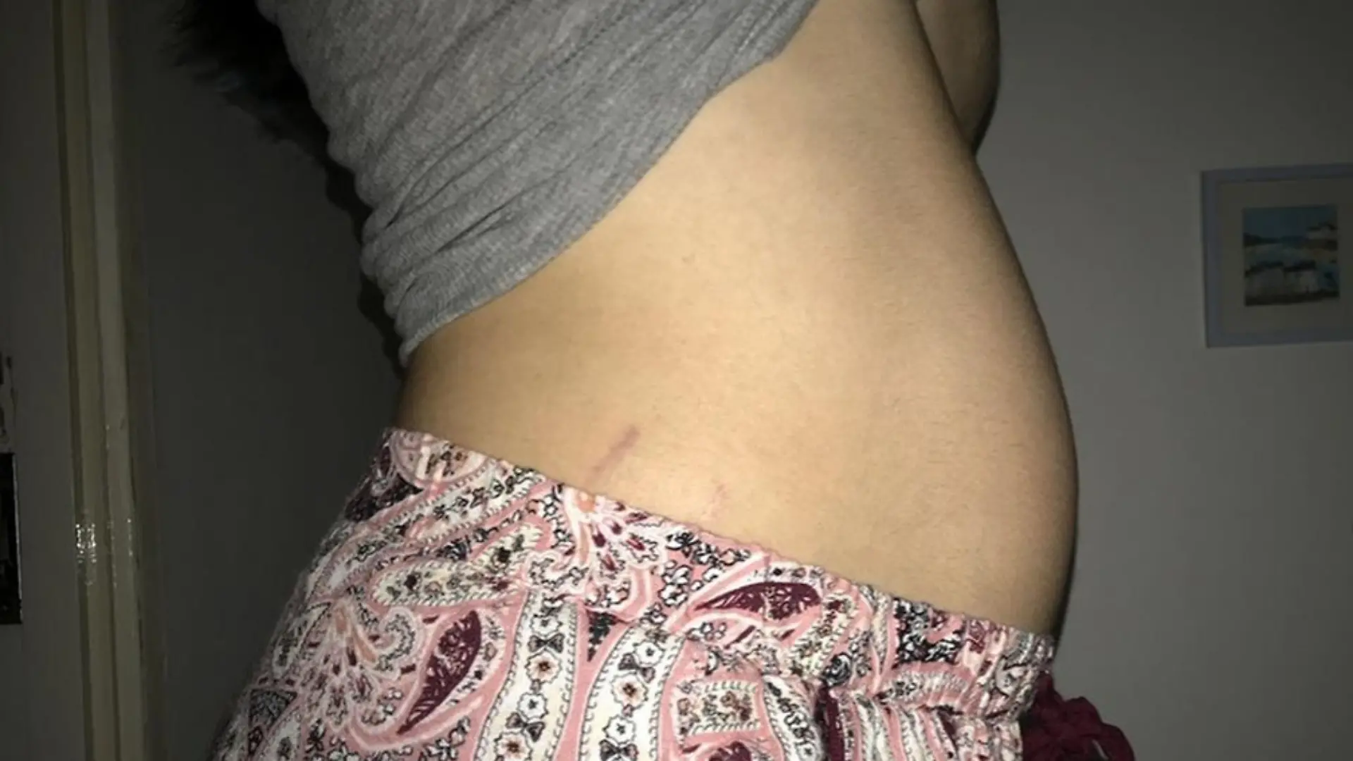 PIC FROM Kennedy News and Media (PICTURED: ELLIE JOHNSON (24) FROM HENHAM, ESSEX, DOCUMENTING HER 'BLOATING' JUST TWO DAYS BEFORE SHE GAVE BIRTH AND ON THE DAY THE DOCTOR DID AN ULTRASOUND ON HER) A student was stunned when her 'stomach ache' turned out to be a BABY - not realising she was pregnant until she saw her baby's HEAD emerge. Ellie Johnson had been suffering abdominal pains but claims six doctors, three pregnancy tests and an ultrasound confirmed she was NOT expecting, while she was also taking the contraceptive pill. The history student began suffering tummy ache in August 2018 and was back and forth to the doctors for months as they believed that she had some sort of 'blockage' in her body. DISCLAIMER: While Kennedy News and Media uses its best endeavours to establish the copyright and authenticity of all pictures supplied, it accepts no liability for any damage, loss or legal action caused by the use of images supplied and the publication of images is solely at your discretion. SEE KENNEDY NEWS COPY - 0161 697 4266