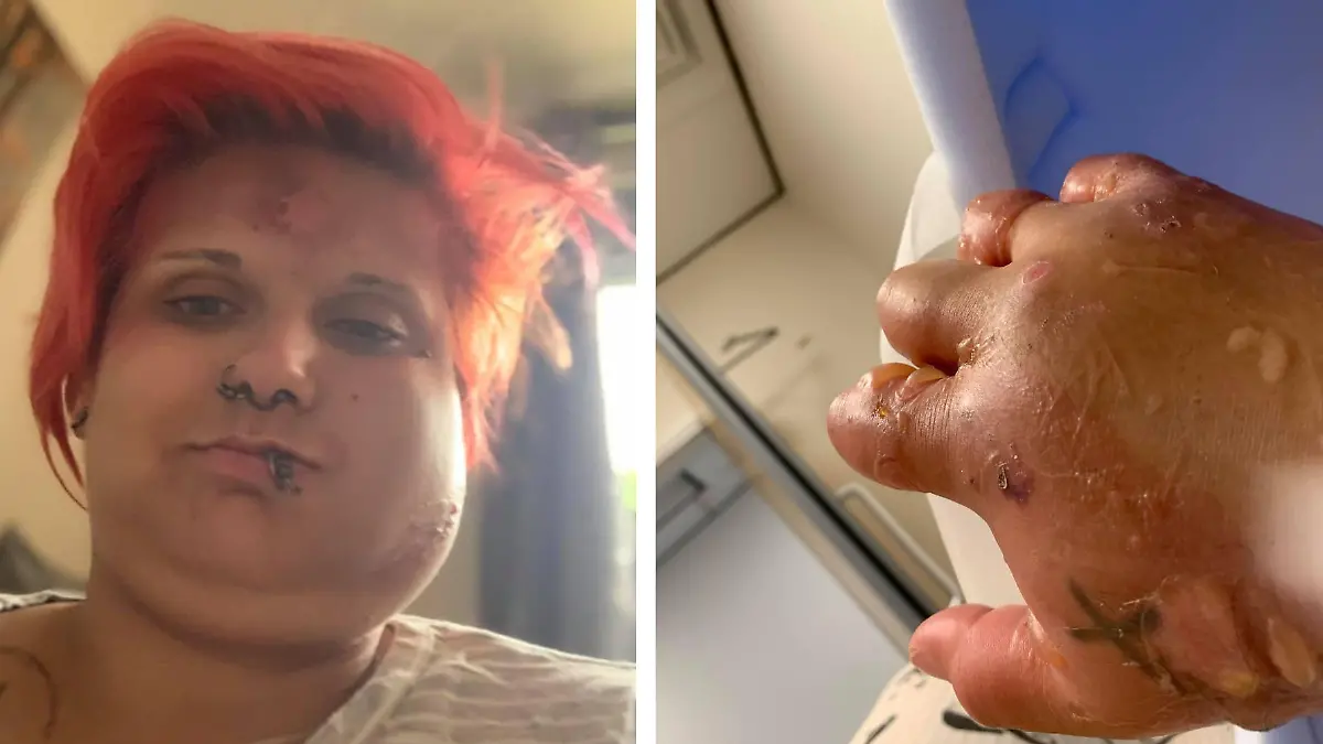 Tina Sabine mit dickem Gesicht und Hand mit Blasen.