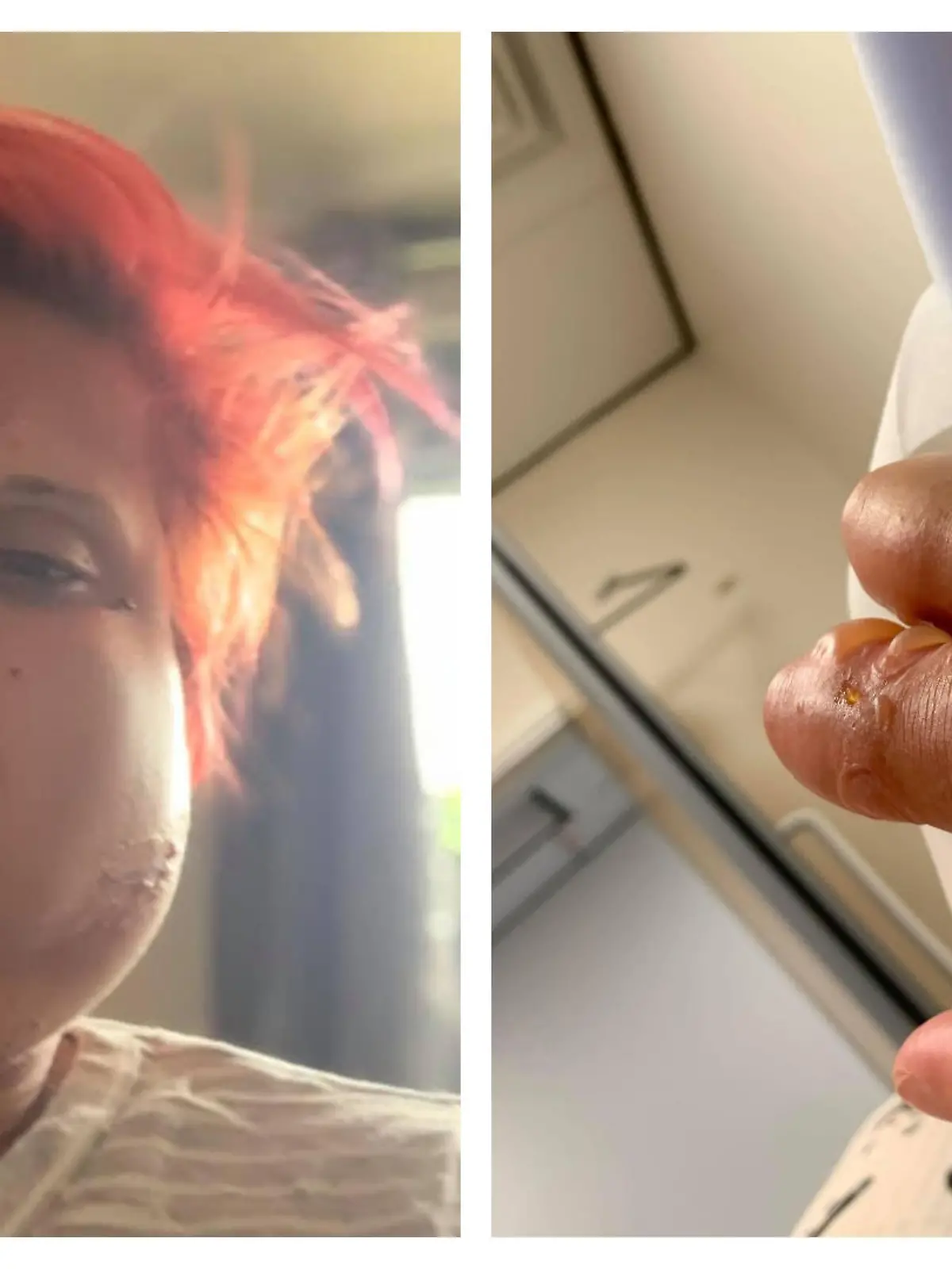 Tina Sabine mit dickem Gesicht und Hand mit Blasen.