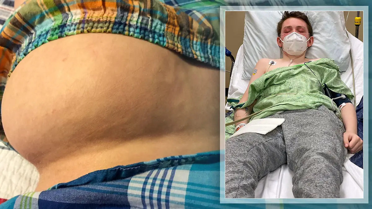 Jaiden Rogers (16) leidet an einer seltenen Krankheit, bei der sein Körper zu Stein wird.