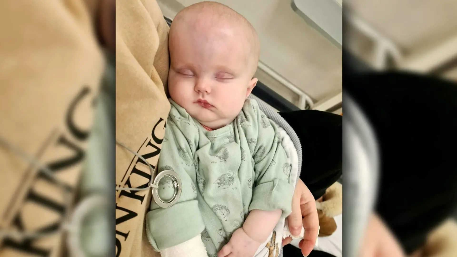 Molly in den Armen ihrer Mutter. Ihr Kopf ist durch einen Tumor extrem angeschwollen.