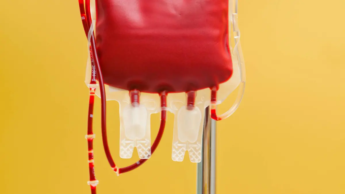 Eine Blutkonserve zur Infusion in eine Klinik. Spenderblut wird verabreicht. McPBBO *** A unit of blood for infusion into a clinic Donor blood is administered McPBBO McPBBO