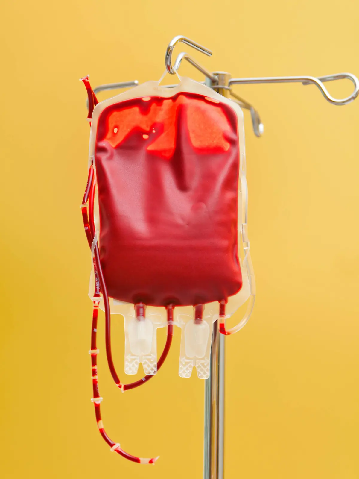  Eine Blutkonserve zur Infusion in eine Klinik. Spenderblut wird verabreicht. McPBBO *** A unit of blood for infusion into a clinic Donor blood is administered McPBBO McPBBO