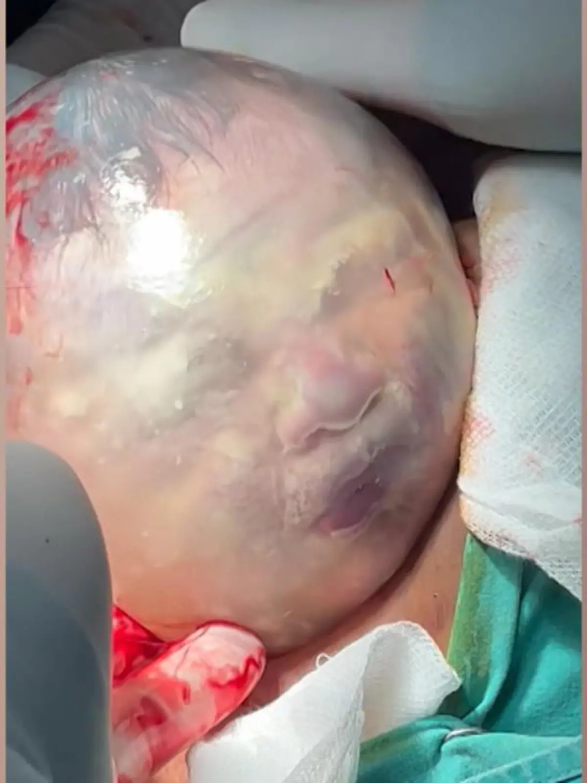 Jede Geburt ist ein kleines Wunder, doch diese ist wirklich spektakulär! In der Türkei sorgte ein Baby bei seiner Kaiserschnitt-Geburt für große Augen: