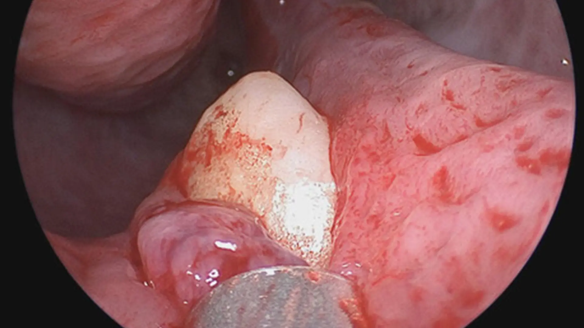 Story from Jam Press (Tooth In Nose)
Pictured: Panel A - Rhinoscopy showing the white mass in the floor of the right nostril, found to be a tooth.
Man, 38, struggling to breathe finds TOOTH growing inside NOSTRIL
A 38-year-old man who was having trouble breathing was left shocked after doctors found he had a tooth growing in his nose.
The patient visited a clinic after struggling with breathing problems through his nose for a number of years.
Doctors examining him found he had a deviated septum – leaving the thin wall between his nostrils displaced to one side – despite the man reporting no facial abnormalities or trauma.
But when they performed a rhinoscopy, they made the grim discovery of a white object in his right nostril.
Bizarrely, it turned out to be an ectopic tooth growing in his nose.
The case was reported in the New England Journal of Medicine by Sagar Khanna and Michael Turner.
They wrote: “Physical examination of the nose showed a septal deviation, calcified septal spurs, and a 2-cm perforation in the posterior septum.
"On rhinoscopy, a hard, nontender, white mass was observed in the floor of the right nostril (Panel A).
"Computed tomography of the paranasal sinuses showed a well-defined, radiodense mass consistent with an inverted ectopic tooth in the nasal cavity (Panel B, arrow), which was thought to explain the obstructive symptoms and septal perforation.
"The tooth was removed during oral and otolaryngologic surgery by means of an intranasal approach and measured 14 mm in length. There were no postoperative complications.
"At follow-up three months after surgery, the patient’s symptoms of nasal obstruction had resolved."
ENDS
