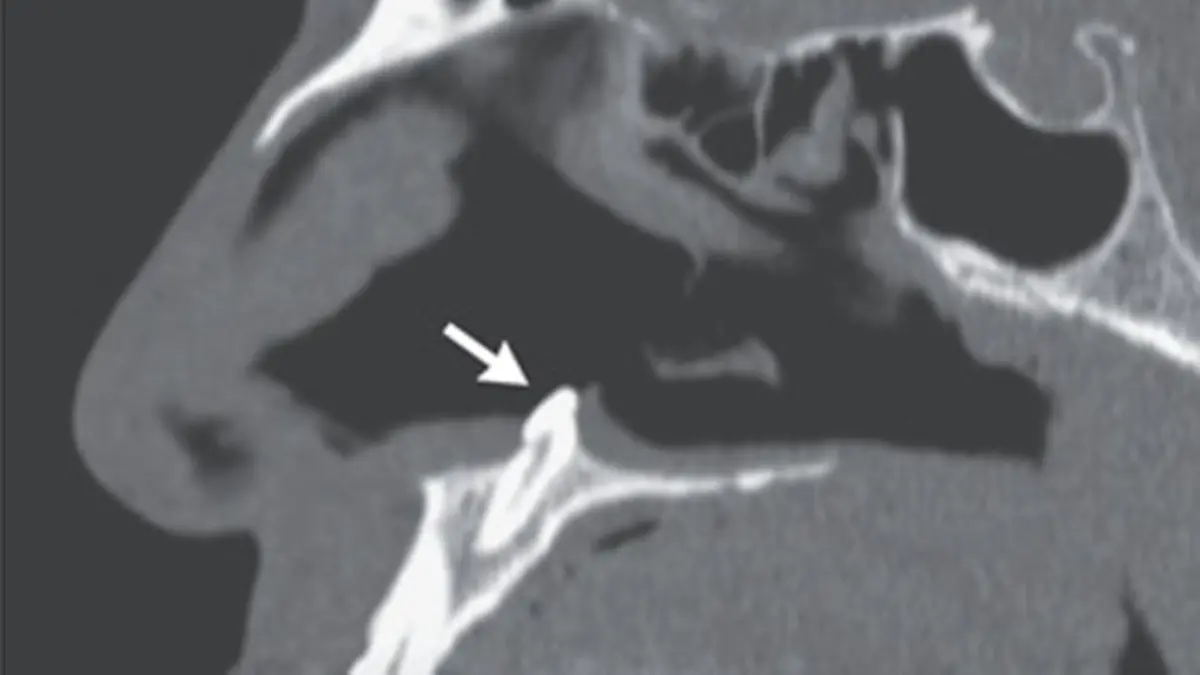 Story from Jam Press (Tooth In Nose)
Pictured: Panel B - Computed tomography of the paranasal sinuses showing the tooth in the nasal cavity.
Man, 38, struggling to breathe finds TOOTH growing inside NOSTRIL
A 38-year-old man who was having trouble breathing was left shocked after doctors found he had a tooth growing in his nose.
The patient visited a clinic after struggling with breathing problems through his nose for a number of years.
Doctors examining him found he had a deviated septum – leaving the thin wall between his nostrils displaced to one side – despite the man reporting no facial abnormalities or trauma.
But when they performed a rhinoscopy, they made the grim discovery of a white object in his right nostril.
Bizarrely, it turned out to be an ectopic tooth growing in his nose.
The case was reported in the New England Journal of Medicine by Sagar Khanna and Michael Turner.
They wrote: “Physical examination of the nose showed a septal deviation, calcified septal spurs, and a 2-cm perforation in the posterior septum.
"On rhinoscopy, a hard, nontender, white mass was observed in the floor of the right nostril (Panel A).
"Computed tomography of the paranasal sinuses showed a well-defined, radiodense mass consistent with an inverted ectopic tooth in the nasal cavity (Panel B, arrow), which was thought to explain the obstructive symptoms and septal perforation.
"The tooth was removed during oral and otolaryngologic surgery by means of an intranasal approach and measured 14 mm in length. There were no postoperative complications.
"At follow-up three months after surgery, the patient’s symptoms of nasal obstruction had resolved."
ENDS