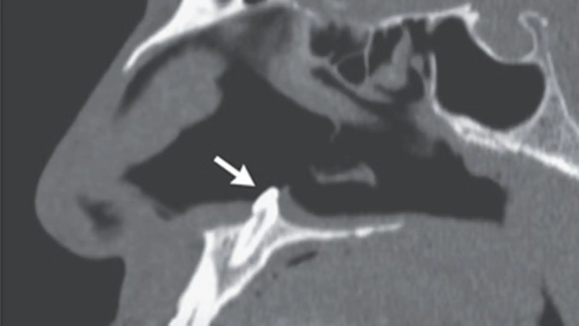 Story from Jam Press (Tooth In Nose)
Pictured: Panel B - Computed tomography of the paranasal sinuses showing the tooth in the nasal cavity.
Man, 38, struggling to breathe finds TOOTH growing inside NOSTRIL
A 38-year-old man who was having trouble breathing was left shocked after doctors found he had a tooth growing in his nose.
The patient visited a clinic after struggling with breathing problems through his nose for a number of years.
Doctors examining him found he had a deviated septum – leaving the thin wall between his nostrils displaced to one side – despite the man reporting no facial abnormalities or trauma.
But when they performed a rhinoscopy, they made the grim discovery of a white object in his right nostril.
Bizarrely, it turned out to be an ectopic tooth growing in his nose.
The case was reported in the New England Journal of Medicine by Sagar Khanna and Michael Turner.
They wrote: “Physical examination of the nose showed a septal deviation, calcified septal spurs, and a 2-cm perforation in the posterior septum.
"On rhinoscopy, a hard, nontender, white mass was observed in the floor of the right nostril (Panel A).
"Computed tomography of the paranasal sinuses showed a well-defined, radiodense mass consistent with an inverted ectopic tooth in the nasal cavity (Panel B, arrow), which was thought to explain the obstructive symptoms and septal perforation.
"The tooth was removed during oral and otolaryngologic surgery by means of an intranasal approach and measured 14 mm in length. There were no postoperative complications.
"At follow-up three months after surgery, the patient’s symptoms of nasal obstruction had resolved."
ENDS