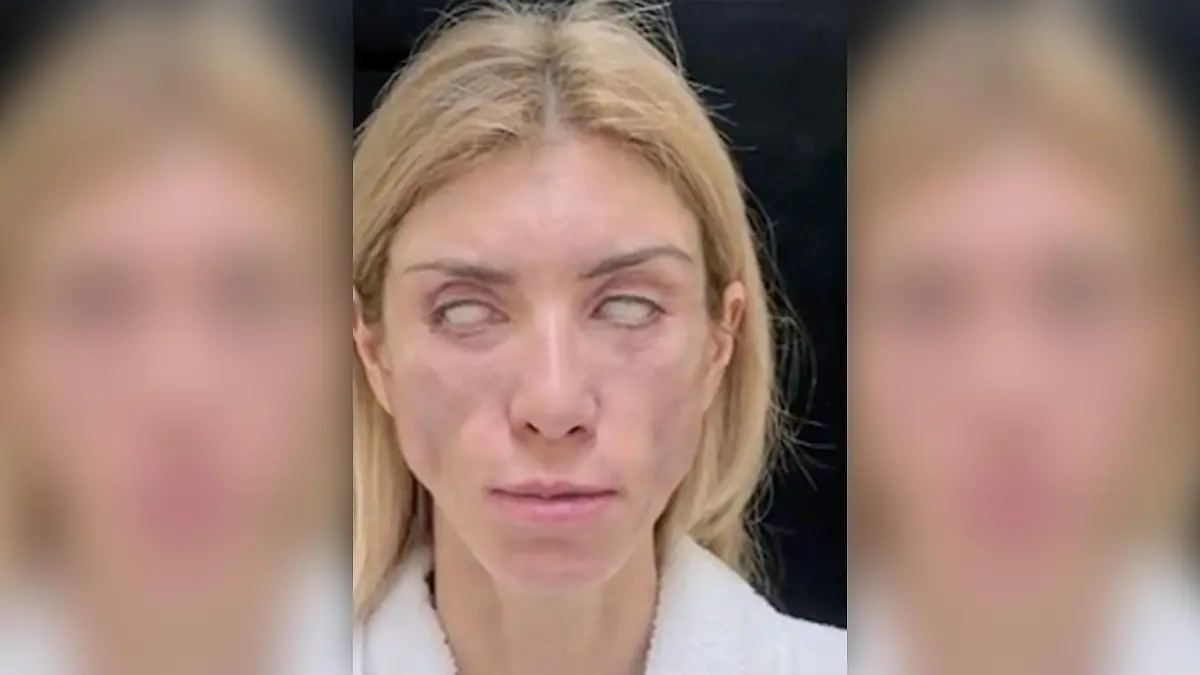 Yulia Tarasevich nach der verpfuschten OP
