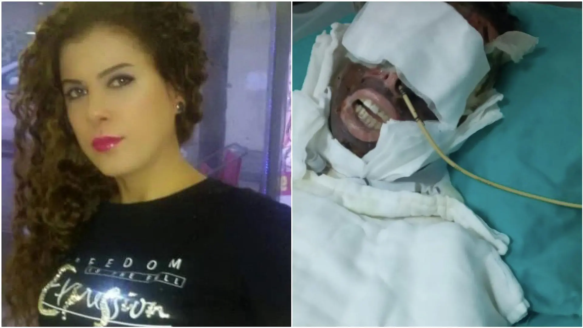 Die Haut bis zur Unkenntlichkeit verbrannt: Nach dem Säureangriff ist für Yasemin Uzuncelebi nichts mehr wie vorher.