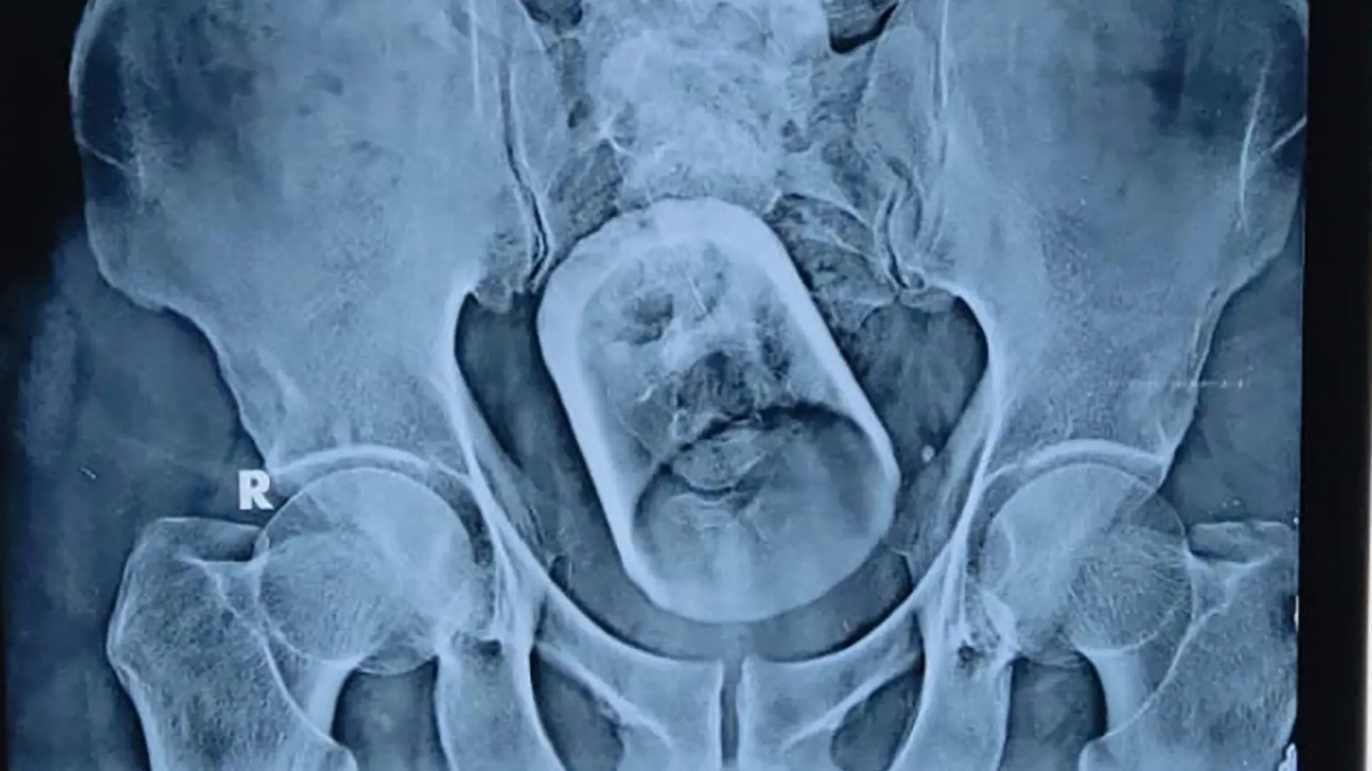 CONTENT WARNING: GRAPHIC PICTURES

Story from Jam Press (Swallowed Cup)

Pictured: An x-ray shows the glass inside the man's stomach.

Doctors remove WHOLE GLASS from man’s STOMACH who ‘swallowed cup while drinking tea’.

Doctors have been left mystified after removing a whole glass from the stomach of a 55-year-old man – who claims he swallowed the cup while drinking tea.

A surgical team operated on the man at a private hospital in Madipur in Bihar, India.

The patient, from Vaishali, was admitted to the hospital with constipation and severe abdominal pain.

He underwent an ultrasound and X-ray, where doctors found a “serious disturbance” in his intestines – which turned out to be a glass.

Doctors struggled to remove the glass from the rectum with an endoscopic procedure, and later had to operate to remove it.

The embarrassed patient claims he swallowed the glass while drinking tea – although doctors said this does not hold up due to the food pipe being too narrow for the object.

Dr Mahmudul Hasan, who headed the team of doctors operating on the patient, said: “How the glass got inside the body of the said patient, it is still a mystery.”

The patient is currently stable.

ENDS