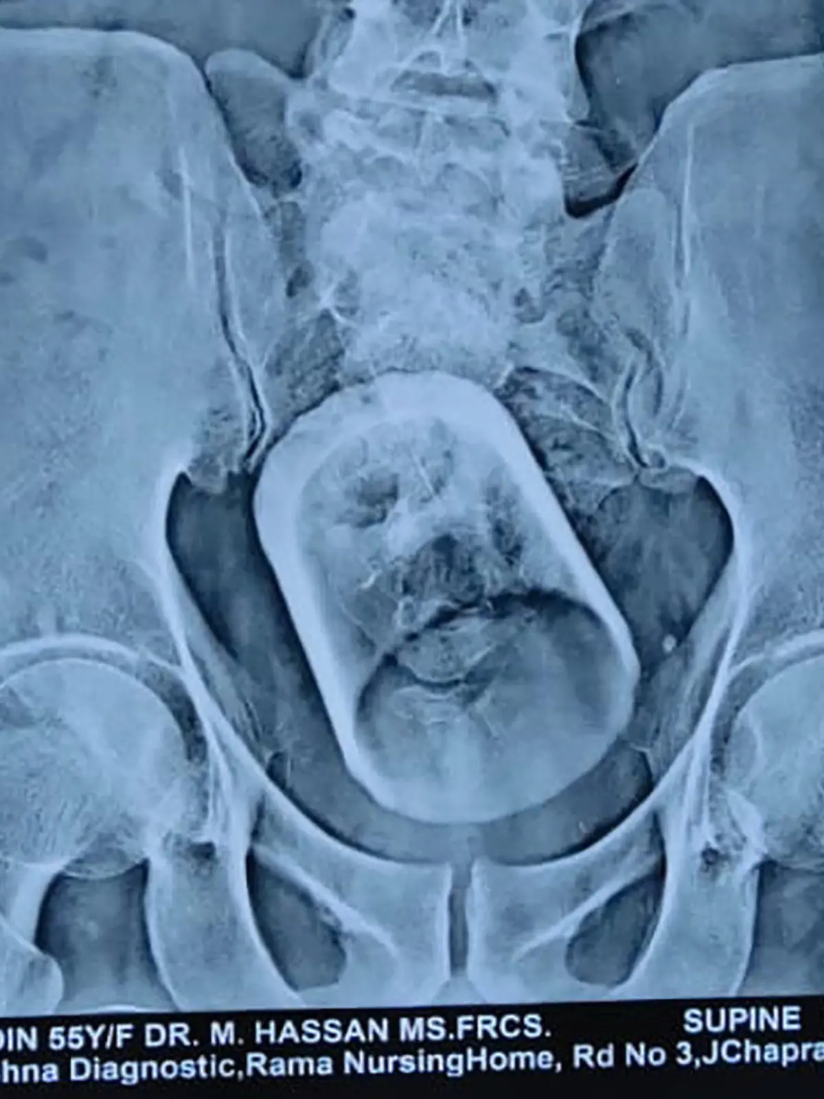CONTENT WARNING: GRAPHIC PICTURES

Story from Jam Press (Swallowed Cup)

Pictured: An x-ray shows the glass inside the man's stomach.

Doctors remove WHOLE GLASS from man’s STOMACH who ‘swallowed cup while drinking tea’.

Doctors have been left mystified after removing a whole glass from the stomach of a 55-year-old man – who claims he swallowed the cup while drinking tea.

A surgical team operated on the man at a private hospital in Madipur in Bihar, India.

The patient, from Vaishali, was admitted to the hospital with constipation and severe abdominal pain.

He underwent an ultrasound and X-ray, where doctors found a “serious disturbance” in his intestines – which turned out to be a glass.

Doctors struggled to remove the glass from the rectum with an endoscopic procedure, and later had to operate to remove it.

The embarrassed patient claims he swallowed the glass while drinking tea – although doctors said this does not hold up due to the food pipe being too narrow for the object.

Dr Mahmudul Hasan, who headed the team of doctors operating on the patient, said: “How the glass got inside the body of the said patient, it is still a mystery.”

The patient is currently stable.

ENDS