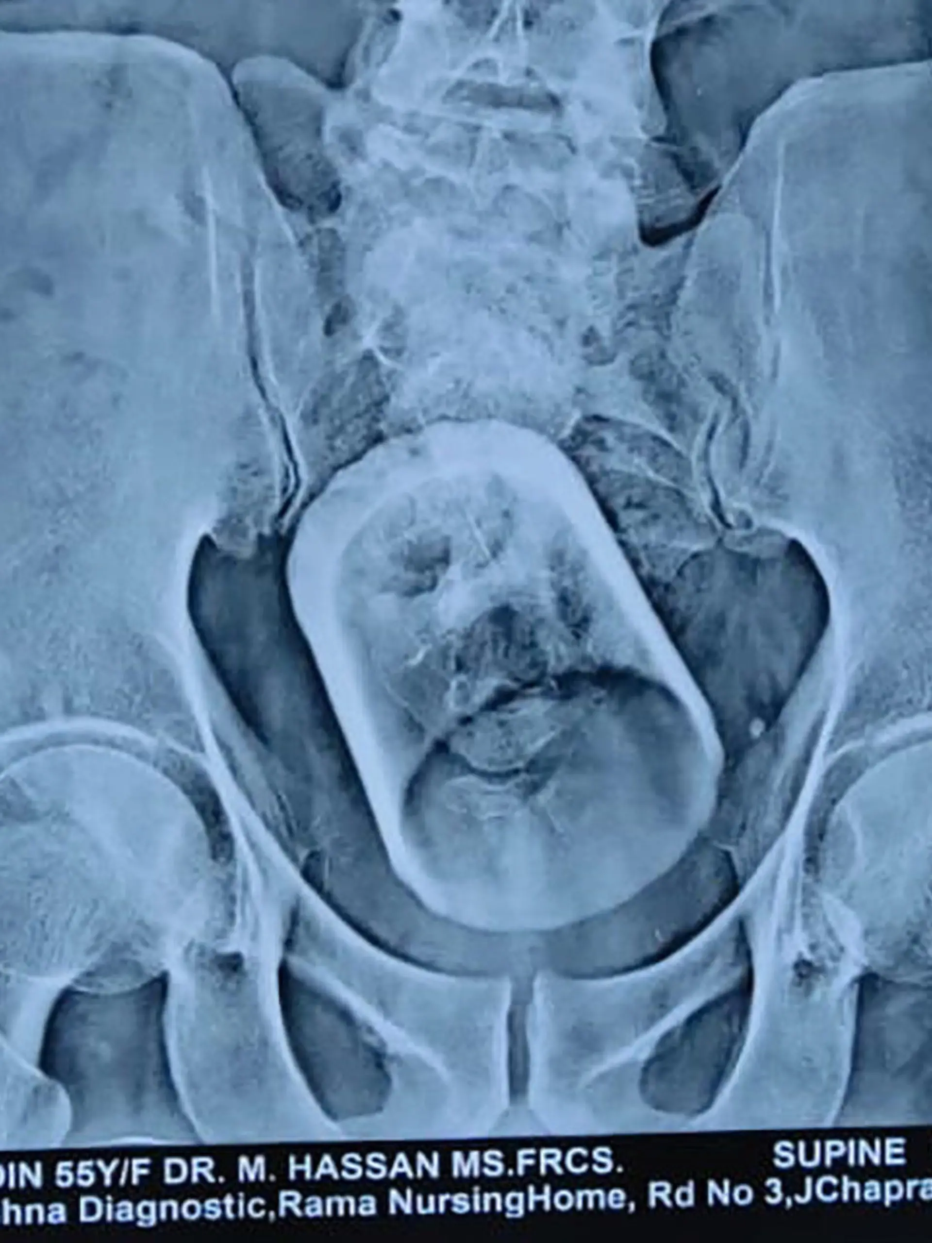 CONTENT WARNING: GRAPHIC PICTURES

Story from Jam Press (Swallowed Cup)

Pictured: An x-ray shows the glass inside the man's stomach.

Doctors remove WHOLE GLASS from man’s STOMACH who ‘swallowed cup while drinking tea’.

Doctors have been left mystified after removing a whole glass from the stomach of a 55-year-old man – who claims he swallowed the cup while drinking tea.

A surgical team operated on the man at a private hospital in Madipur in Bihar, India.

The patient, from Vaishali, was admitted to the hospital with constipation and severe abdominal pain.

He underwent an ultrasound and X-ray, where doctors found a “serious disturbance” in his intestines – which turned out to be a glass.

Doctors struggled to remove the glass from the rectum with an endoscopic procedure, and later had to operate to remove it.

The embarrassed patient claims he swallowed the glass while drinking tea – although doctors said this does not hold up due to the food pipe being too narrow for the object.

Dr Mahmudul Hasan, who headed the team of doctors operating on the patient, said: “How the glass got inside the body of the said patient, it is still a mystery.”

The patient is currently stable.

ENDS