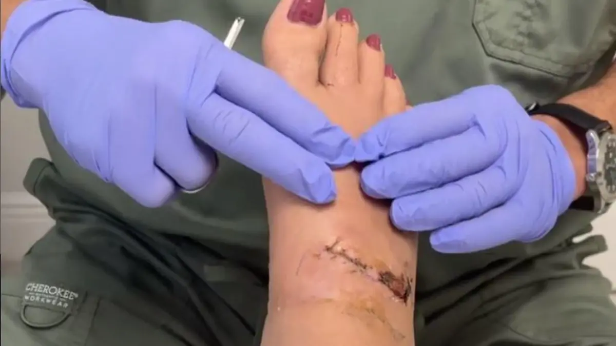 Bei einer Untersuchung von Heathers Fuß kam heraus, dass sie wieder vollkommen gesund wird.