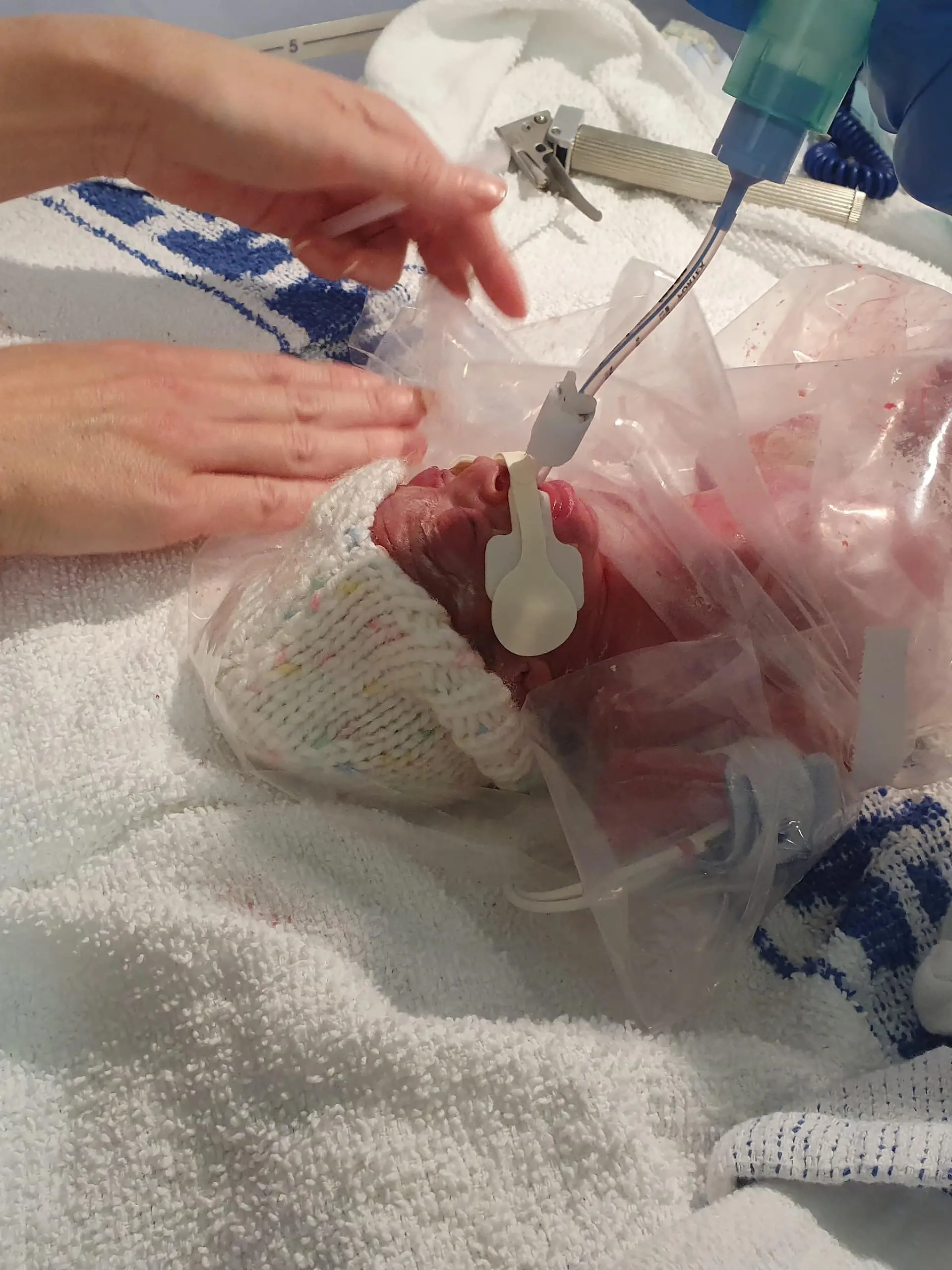 SONDERKONDITIONEN: Satzpreis!
Baby Faith Findlay. See SWNS story SWFTsandwich. A baby born 15 weeks premature was so tiny doctors put her into a SANDWICH BAG to keep her warm and mimic her mother's womb. Little Faith Findlay weighed just 1lbs 15oz when she was delivered by emergency c-section at 26 weeks on 13th September 2020 at the James Cook University Hospital, Middlesbrough, North Yorkshire - three months before her due date.  Doctors immediately bundled Faith into a see-through sandwich bag - which mimics the womb and aims to prevent her body temperature dropping. Faith - who was lighter than half a bag of sugar and smaller than her mother's hand - was rushed to intensive care, where doctors told her parents they didn't know if she would make it or not.  / action press