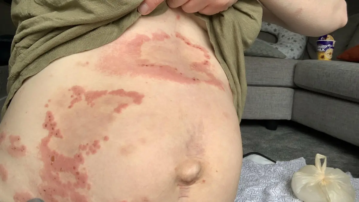 PIC FROM Kennedy News and Media (PICTURED: FIONA HOOKER, 32, FROM BASINGSTOKE, HAMPSHIRE, DURING A POSTPARTUM FLARE UP OF RARE CONDITION PEMPHIGOID GESTATIONIS) A mum who erupted in agonising blisters and welts all over her body was stunned to discover she was 'allergic' to her own BABY. Fiona Hooker, from Basingstoke, Hampshire, first noticed itchy red areas on her stomach at 31 weeks pregnant, which she says felt like 'nettle stings' and got progressively worse. After suffering through the remainder of her pregnancy covered in 'unbearable red itchy plaques' on her skin, the 32-year-old says the condition 'exploded' into incredibly painful blisters once she gave birth. DISCLAIMER: While Kennedy News and Media uses its best endeavours to establish the copyright and authenticity of all pictures supplied, it accepts no liability for any damage, loss or legal action caused by the use of images supplied and the publication of images is solely at your discretion. SEE KENNEDY NEWS COPY - 0161 697 4266