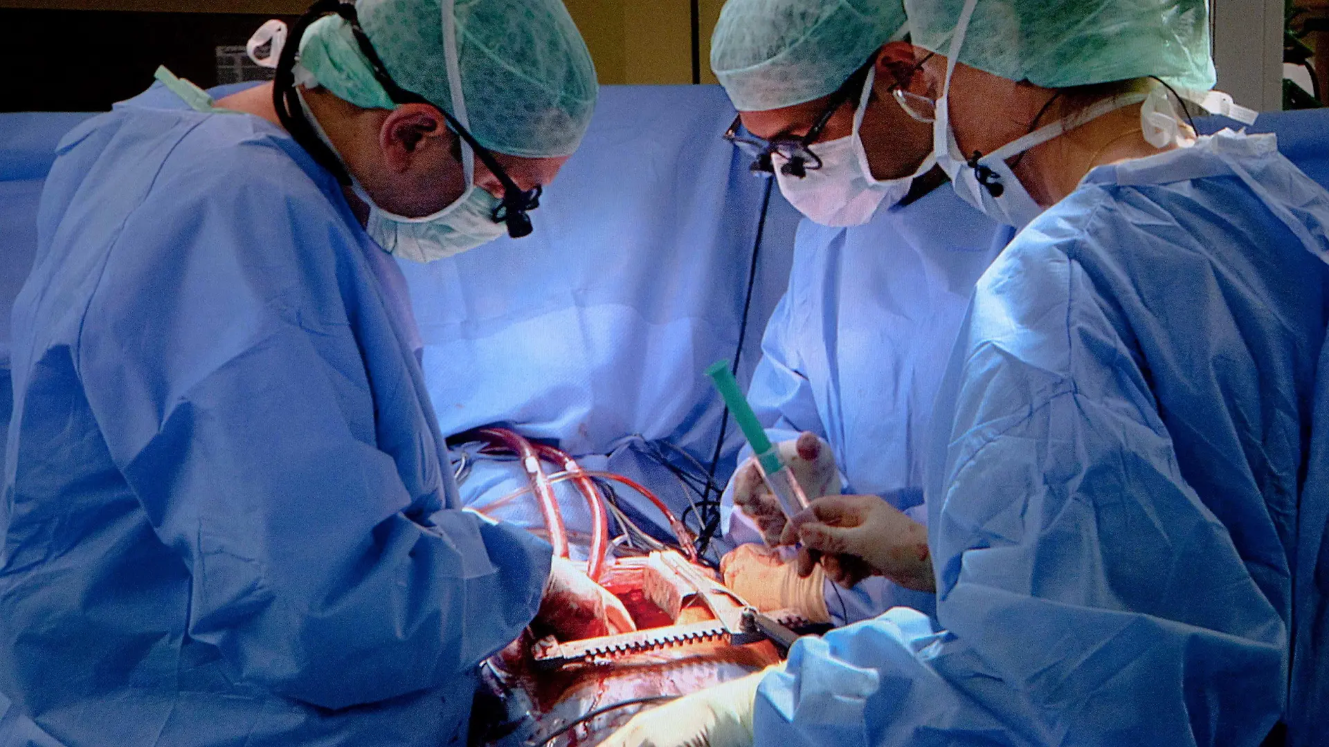 HANDOUT - Ärzte der Universitätklinik in Tübingen (Baden-Württemberg) operieren einen Patienten am Herzen, undatiertes Handout. Das SWR Fernsehen dokumentiert mit einer 90-Minuten-Reportage eine Bypass-Operation an der Uniklinik Tübingen. Nach Angaben des Südwestrundfunks (SWR) ist es die erste Operation am offenen Herzen, die aus einer deutschen Klinik übertragen wird. Den Ärzten und Assistenten blicken bei dem medizinischen Eingriff vier Kameras über die Schulter, ein Reporter berichtet live aus dem Operationssaal. Ausgestrahlt wird die Sendung am 28.11.2012. Foto: Peter A.Schmidt/SWR/dpa (zu lsw: "SWR Fernsehen überträgt Herzoperation" vom 26.11.2012 - Achtung: Verwendung im engen inhaltlichen, redaktionellen Zusammenhang mit genannter SWR-Sendung bei Nennung "Bild: SWR/Peter A. Schmidt")  +++(c) dpa - Bildfunk+++