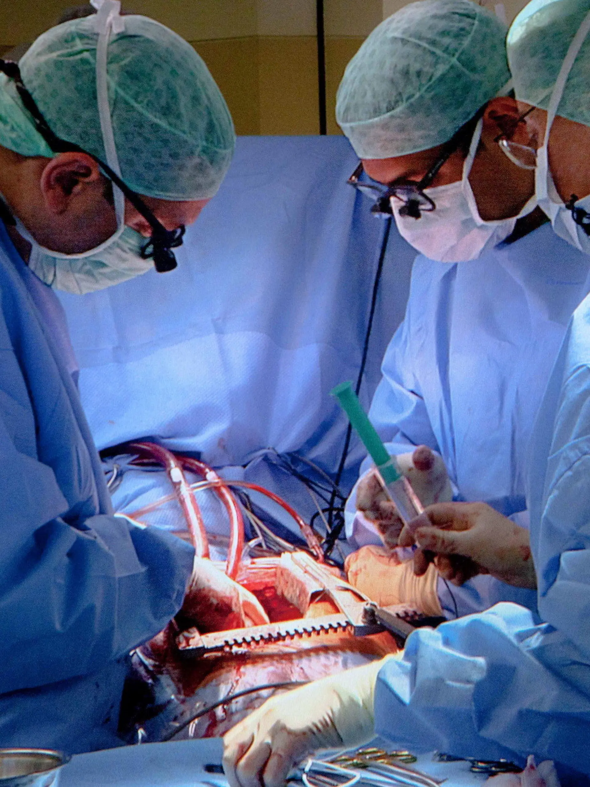 HANDOUT - Ärzte der Universitätklinik in Tübingen (Baden-Württemberg) operieren einen Patienten am Herzen, undatiertes Handout. Das SWR Fernsehen dokumentiert mit einer 90-Minuten-Reportage eine Bypass-Operation an der Uniklinik Tübingen. Nach Angaben des Südwestrundfunks (SWR) ist es die erste Operation am offenen Herzen, die aus einer deutschen Klinik übertragen wird. Den Ärzten und Assistenten blicken bei dem medizinischen Eingriff vier Kameras über die Schulter, ein Reporter berichtet live aus dem Operationssaal. Ausgestrahlt wird die Sendung am 28.11.2012. Foto: Peter A.Schmidt/SWR/dpa (zu lsw: "SWR Fernsehen überträgt Herzoperation" vom 26.11.2012 - Achtung: Verwendung im engen inhaltlichen, redaktionellen Zusammenhang mit genannter SWR-Sendung bei Nennung "Bild: SWR/Peter A. Schmidt")  +++(c) dpa - Bildfunk+++