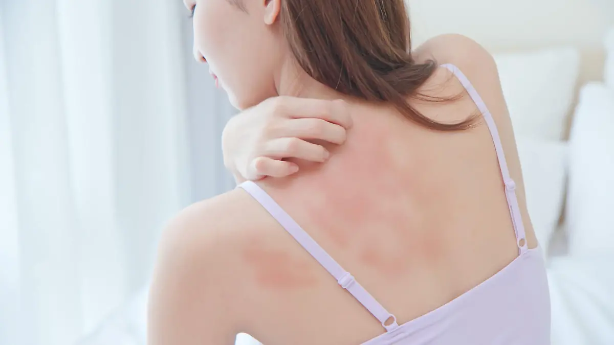 asian beauty woman has dry skin and scratching her back