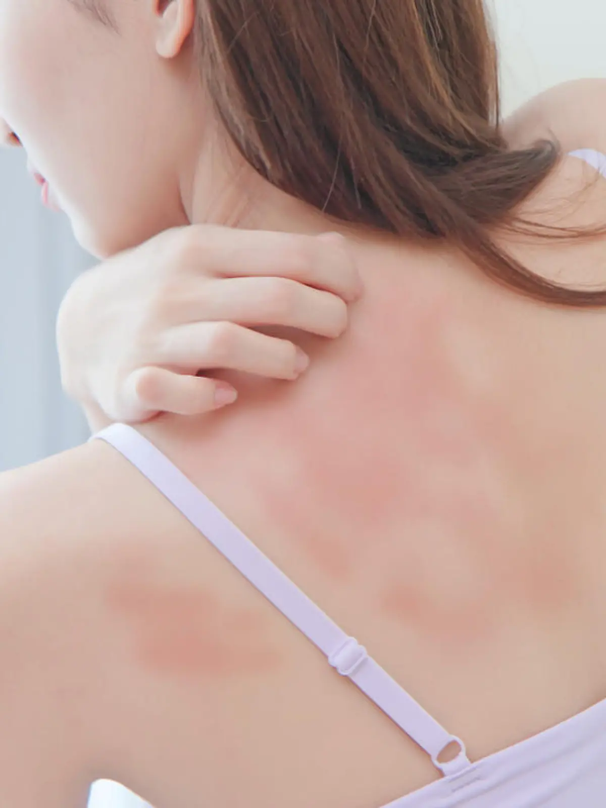 asian beauty woman has dry skin and scratching her back
