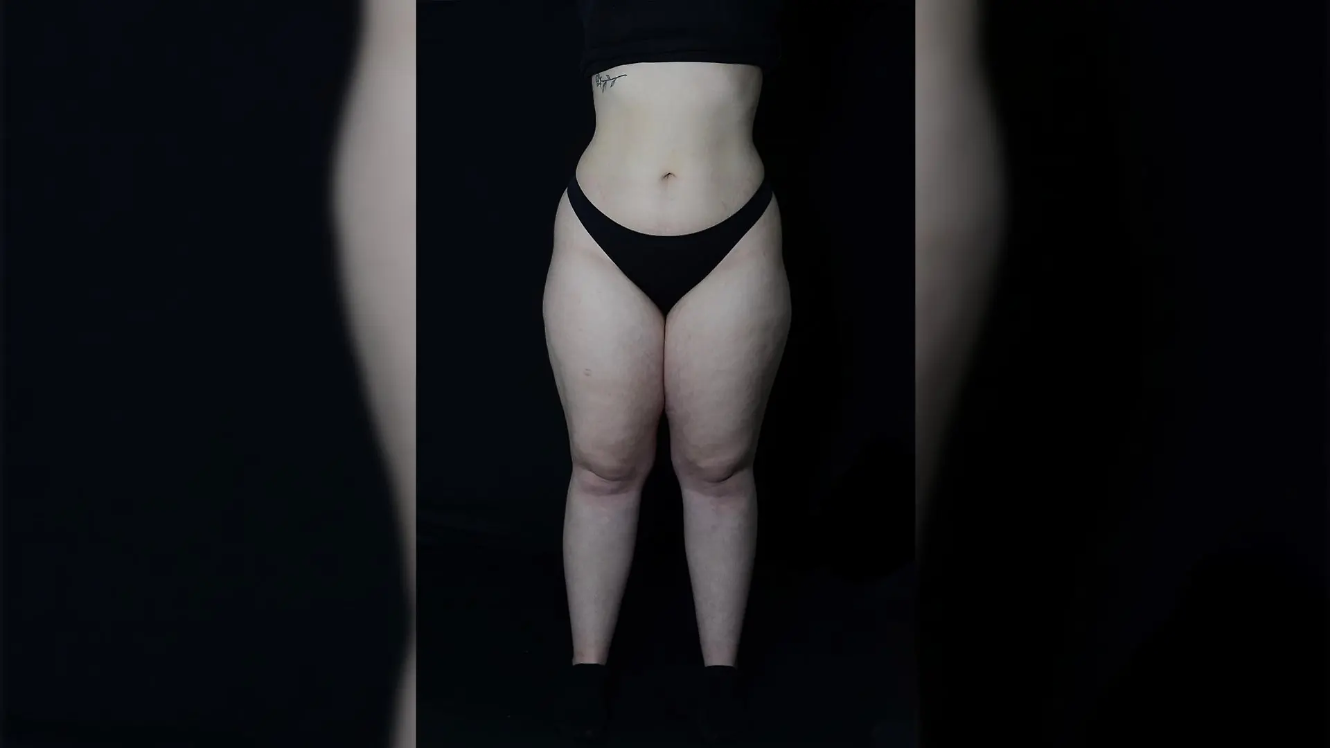 Das erste Bild von Kimberly, nachdem sie die Diagnose Lipödem erhalten hat.