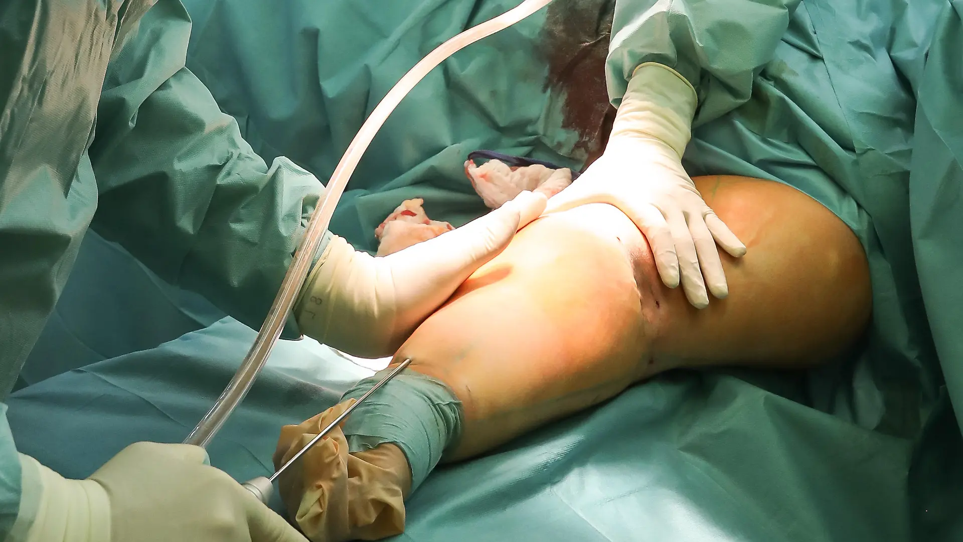 Hannover, 04.02.2019 : Schönheitschirurg Dr. Slobodan Reba operiert Patientin Nadine S. 25 mit Lipödem an den Armen. Bei der OP am rechten Arm hat der Dr. bereits über 6Kg aus dem Arm gesaugt. In der 3-Stündigen OP wird diesesmal sogar noch mehr erwartet. Hannover Niedersachsen Deutschland *** Hanover, 04 02 2019 Plastic surgeon Dr Slobodan Reba operates on patient Nadine S 25 with lipedema on her arms During the operation on her right arm, the Dr has already sucked more than 6 kg out of her arm In the 3 hour operation, even more is expected this time Hanover Lower Saxony Germany