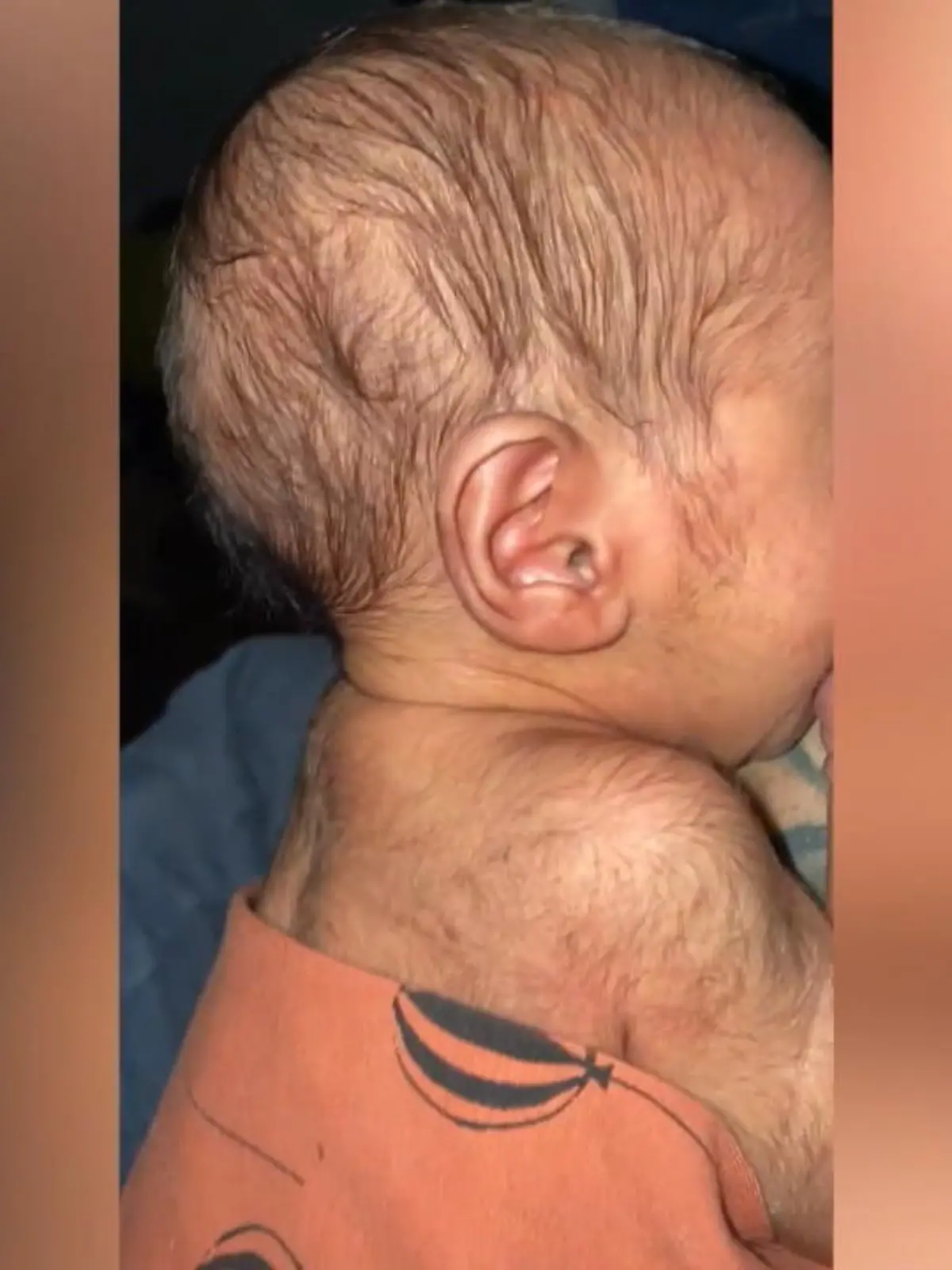 Das Kind kam als Frühchen auf die Welt. Haare, die Babys ganz normal im Mutterleib haben, hatten sich noch nicht zurückentwickelt.