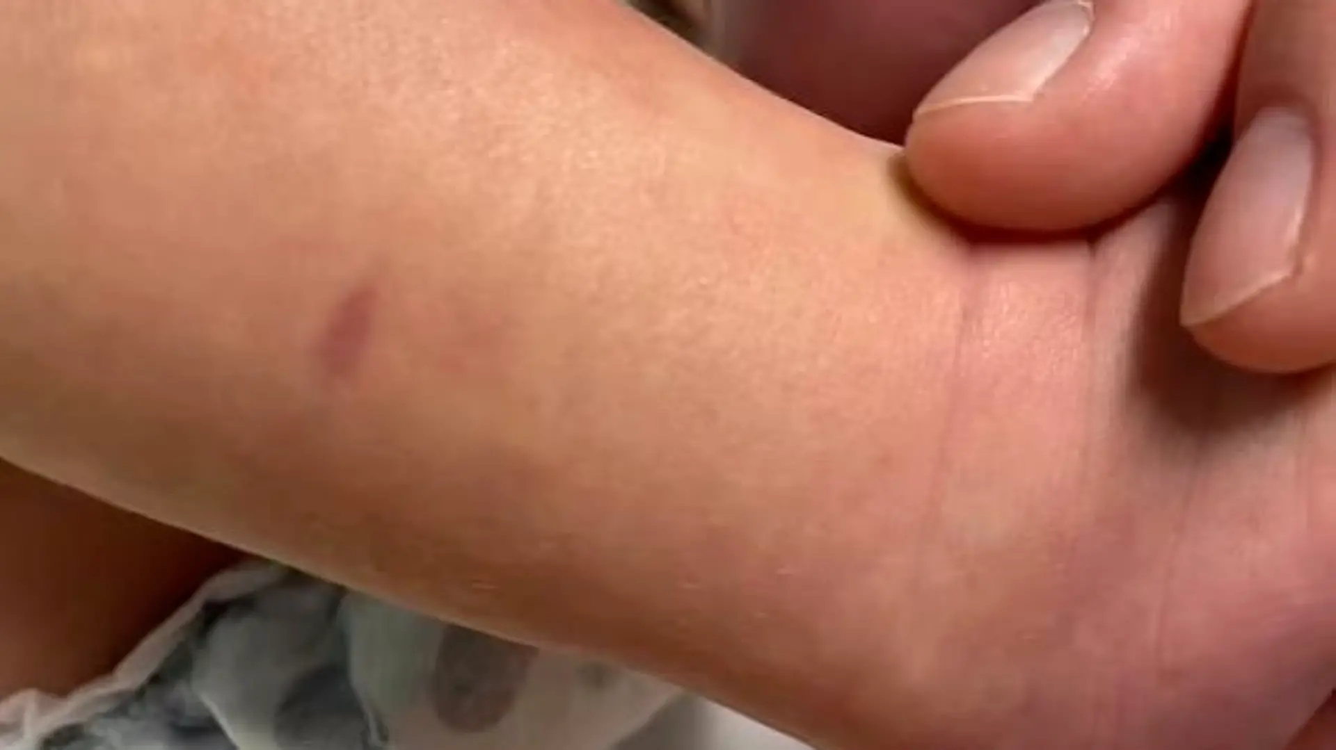 Symptom einer Meningokokken-Erkrankung. Ein Lila Fleck am Bein eines Babys.