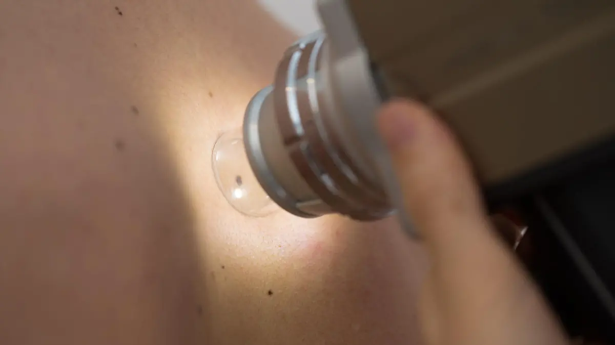 Close-up of Dermatologist Checking Moles with Dermatoscope