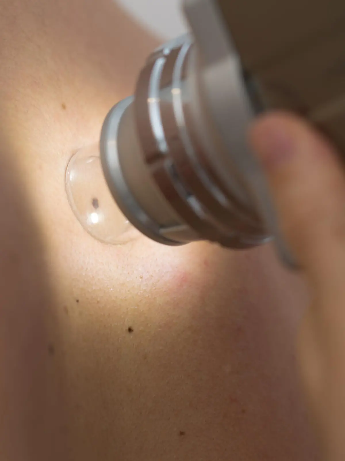 Close-up of Dermatologist Checking Moles with Dermatoscope
