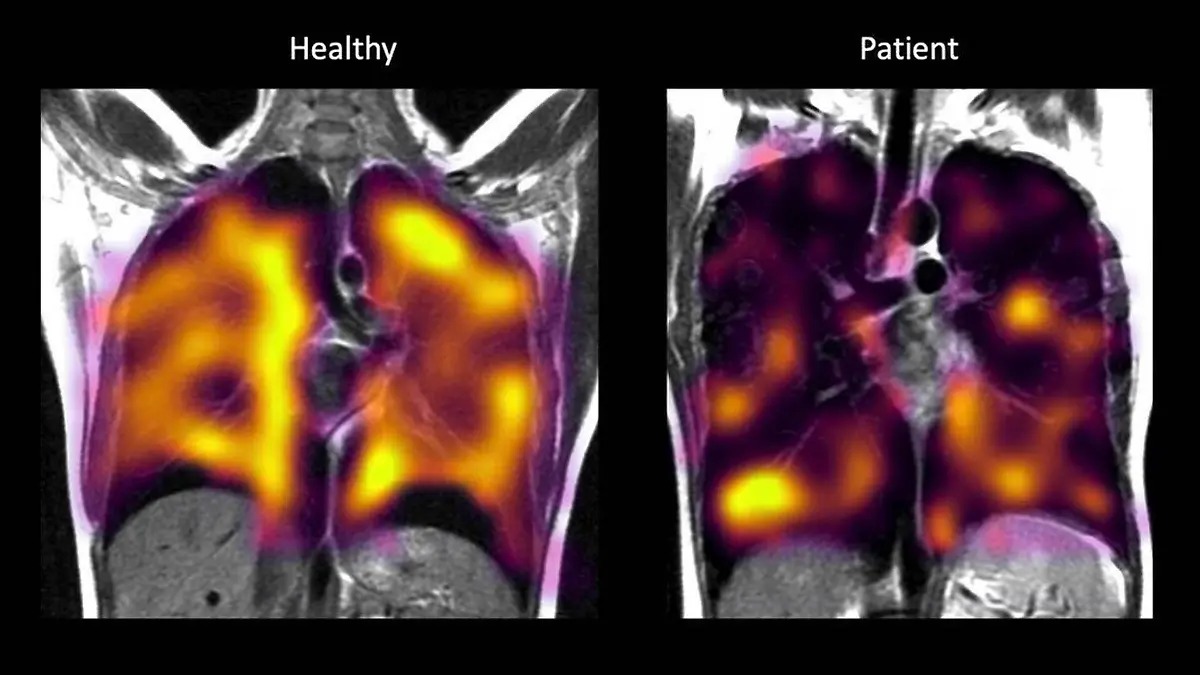 Oxford Study Covid Lunge Damage