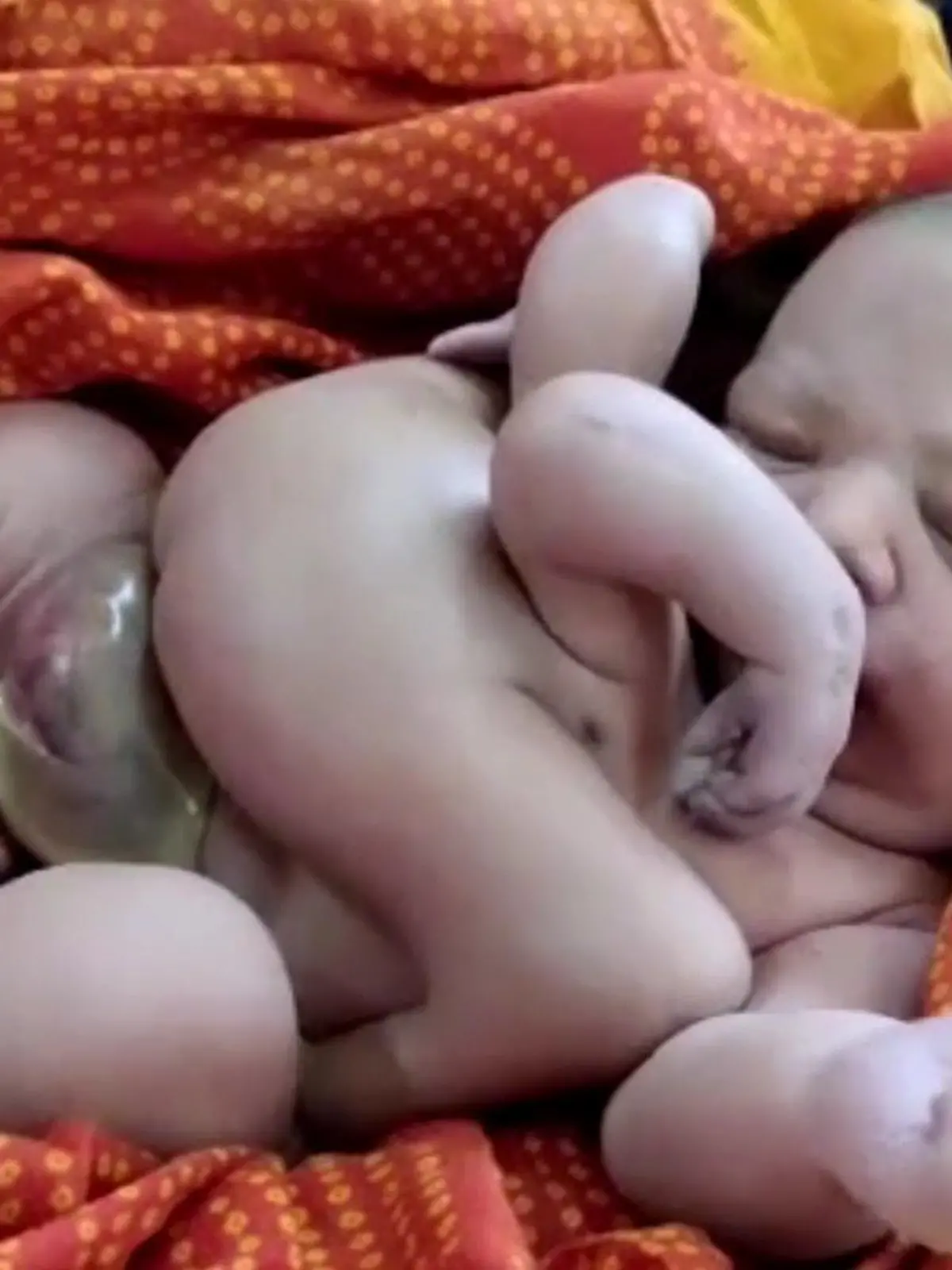 Baby mit vier Armen und vier Beinen Indien