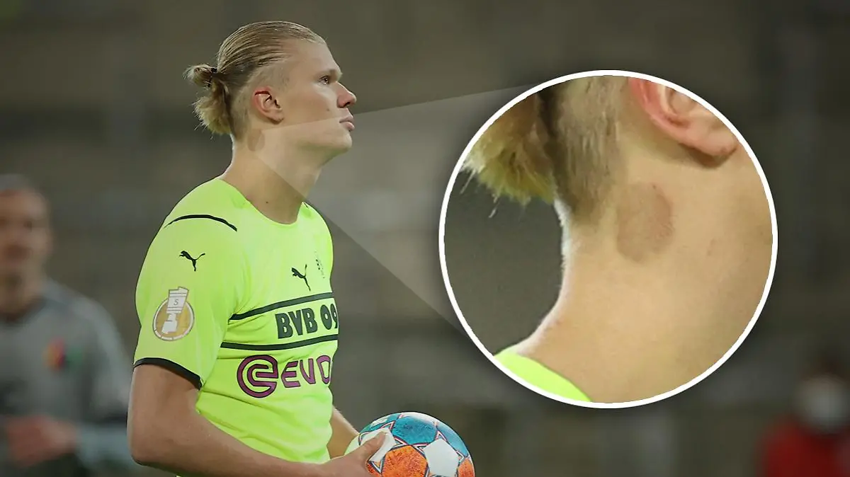 Erling Haaland mit Fleck am Hals