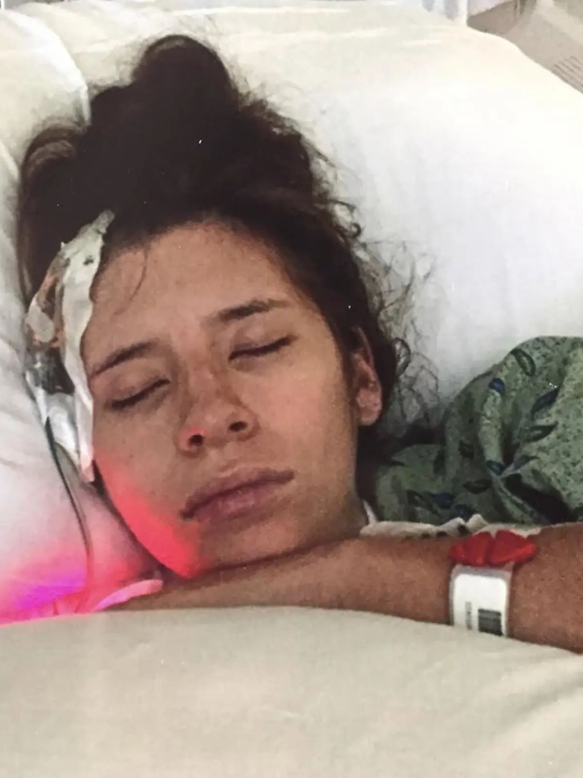 Story from Jam Press (Brain Pop Stroke)

Pictured: Bridget in hospital after the stroke.

Mum reveals how her brain 'popped' and caused a stroke as she picked up her daughter on a hike

A mum has revealed how she suffered a stroke when a blood vessel in her brain popped as she bent down to pick up her daughter.

Bridget Chiovari, 30, from Arizona, US, was on a hike with friends and their children but they stopped for a break and she took her 18-month-old daughter Liliana out of her carrier.

As the mum, who also was 24 weeks pregnant with her second child at the time, went to put Liliana back in the carrier, she felt a pop sensation in her head.

"Immediately after I felt the 'pop' I was hit by some intense dizziness and a horrific headache," she told Jam Press.

She managed to hike home and thought it would go away.

Later that evening, with the headache getting worse, her husband Chris, 33, took her to hospital.

She said: "I told them I felt a pop, and then an awful headache.

"I even said 'I've never had a brain aneurysm before but I imagine that this is what it must feel like.'

"They hooked me up to an IV bag, gave me some Tylenol, told me it was dehydration, then sent me home to 'sleep it off'.

"Within 12 minutes of leaving the hospital, I had lost my ability to form words."

Returning to the hospital, her husband demanded a CT scan which showed Bridget actually had an arteriovenous malformation - a tangle of abnormal blood vessels which had become so tangled, one had burst, causing a massive stroke.

Bridget had been born with the ticking time-bomb and had no idea it was there until the moment it popped.

Bridget said: "I had an interventricular drain placed into my skull. This allows that excess blood and fluids to leave your body while they wait for the swelling of the brain to go down. This is the part that saved my life."

The mum didn't even know that what was happened was a stroke until she joined a Facebook group for other AVM surviours and someone e