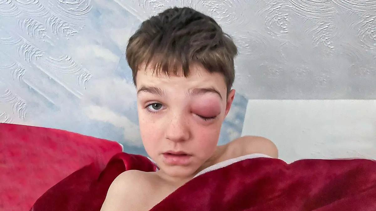 Das linke Auge des Jungen ist komplett zugeschwollen.