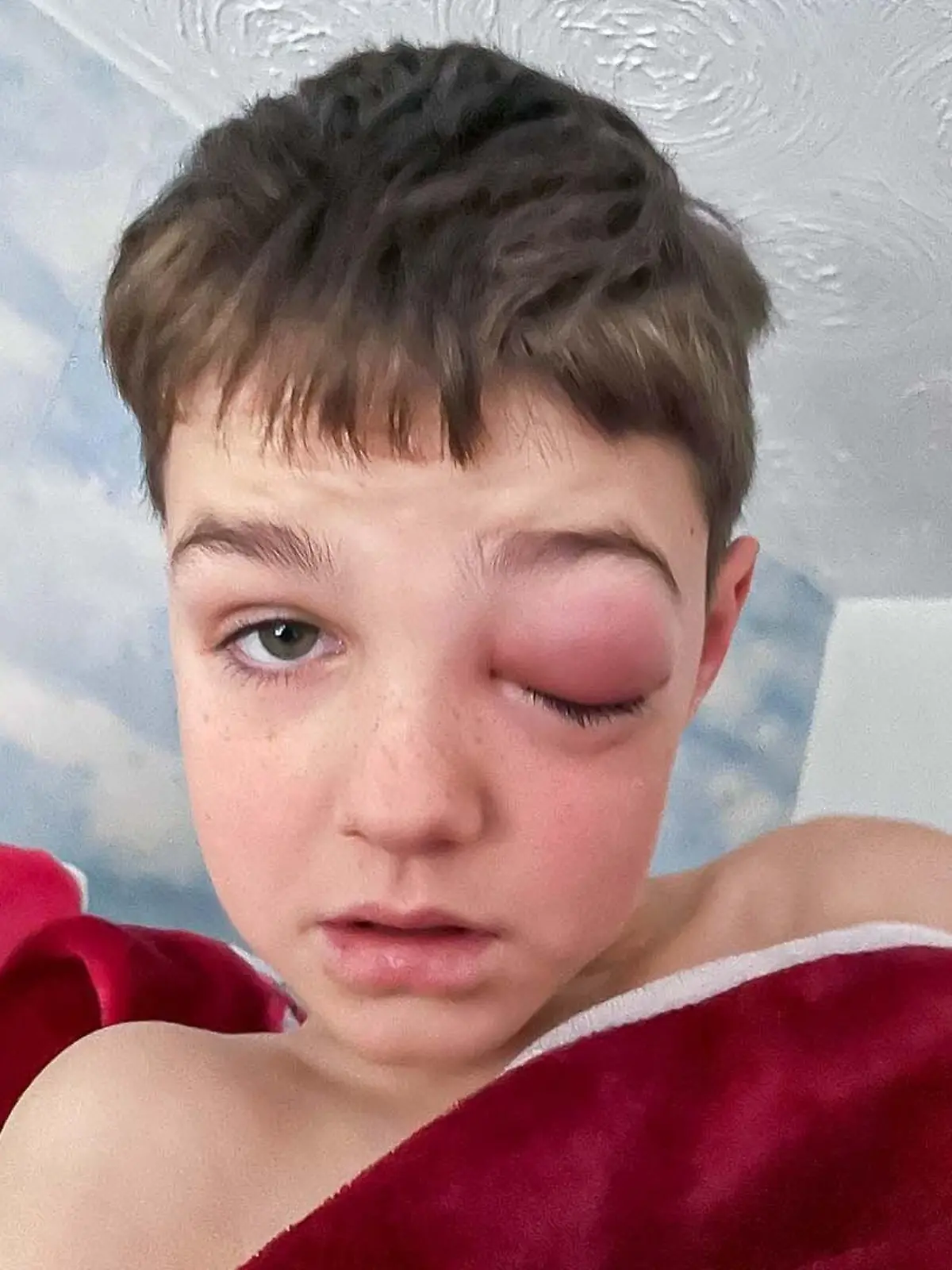 Das linke Auge des Jungen ist komplett zugeschwollen.