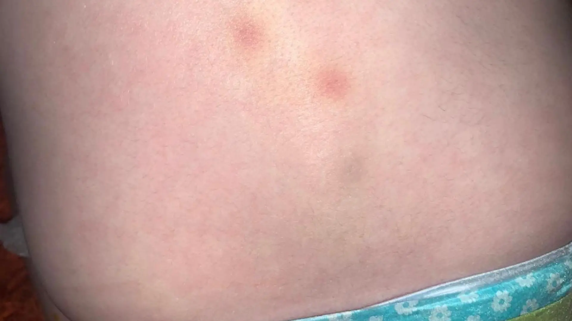Story from Jam Press (Baby Blood Cancer)
Pictured: The pinprick bruising Charlotte Shaughnessy noticed on bay Isla that led to her diagnosis.
'It’s scary how much your life can change overnight,' says mum who spotted pinprick rash on toddler that turned out to be CANCER
A mum has revealed how tiny pinpricks and bruising on her baby daughter’s skin led to doctors diagnosing the tot with blood cancer.
Back in June 2021, Charlotte Shaughnessy, 28, noticed Isla, then 10-months-old, was not her normal self and had become very clingy, irritable and tired.
The retail supervisor from Llansamlet, Swansea, noticed some faint bruising on her elbow and creeping up her spine and a pinprick rash on her chest.
Charlotte, who shares Isla and son Cody, six, with partner Rich, 31, assumed the little girl might be teething but after getting home from work one evening quickly realised something wasn’t right.
“I went up to check on Isla and to kiss her goodnight and as soon as I could see the bruising had spread up her spine my mother’s instinct kicked in,” Charlotte told Jam Press.
“I just knew something was wrong so I rang 111 and after assessing Isla over the phone they told me to take her straight to Morriston Hospital.
“Within hours, doctors told me that they were testing her for leukaemia.
“I would never have expected in a million years to have been hit with that news.
“I thought it might be a viral infection, possibly meningitis but you never expect it to be cancer. Ever.
“It’s scary how much your life can change overnight and you never think it’s going to happen to you.”
After the initial consultation, Isla needed a platelet transfusion before being transferred to Noah’s Ark Children’s Hospital in Cardiff for further testing.
Just days after entering hospital, Charlotte and Rich were told the devastating news their daughter had infant acute lymphoblastic leukaemia.
Thankfully Isla's condition was not terminal.
Doctors praised