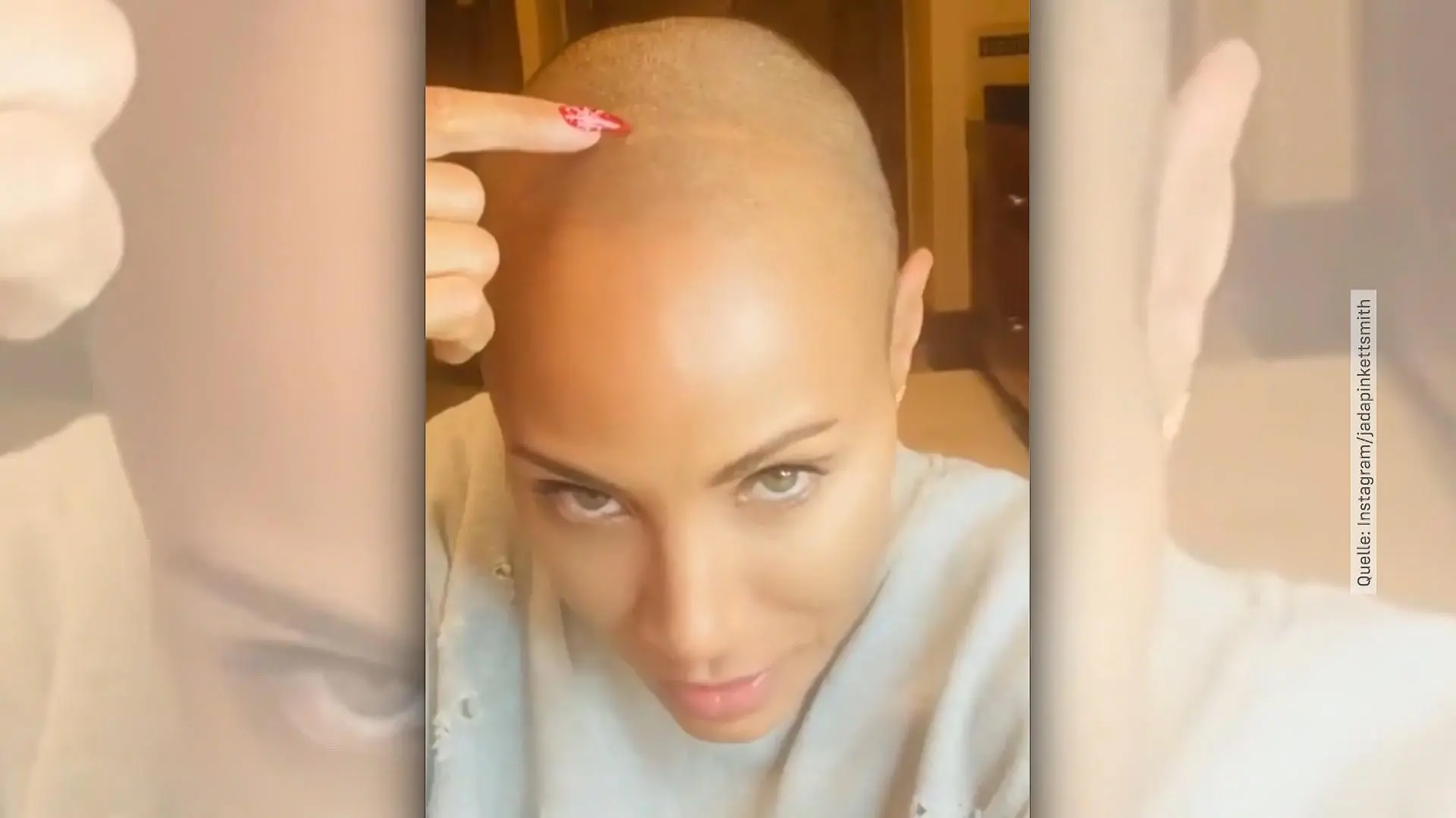 Jada Pinkett Smith lebt selbstbewusst mit Haarausfall Schauspielerin offenbart sich