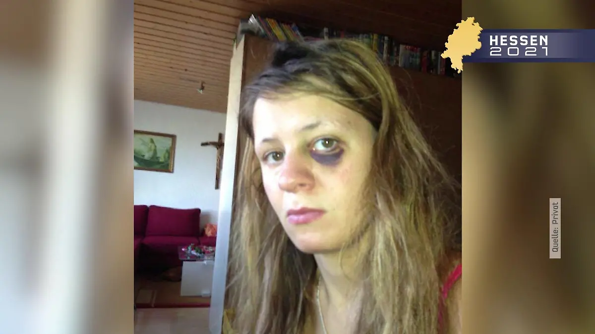 Svenja Beck nach dem Angriff ihres damaligen Freundes