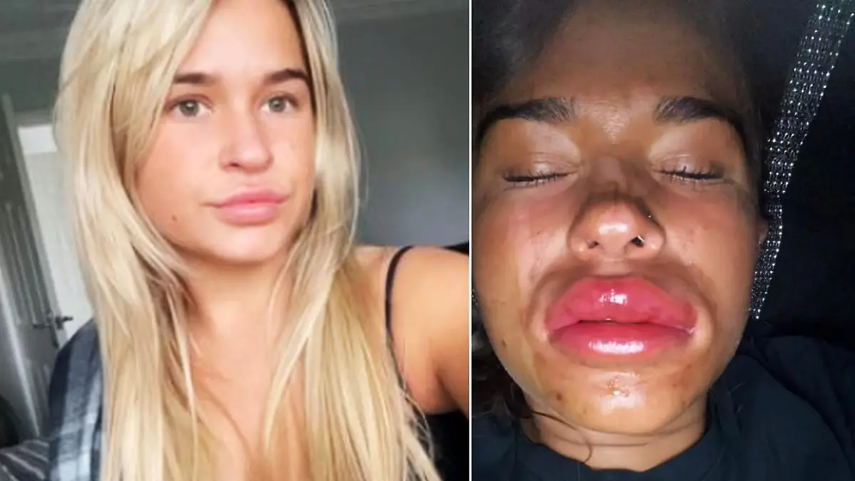 Links sieht man Morgan vor der Injektion und rechts einige Stunden nach dem Lipfilling.