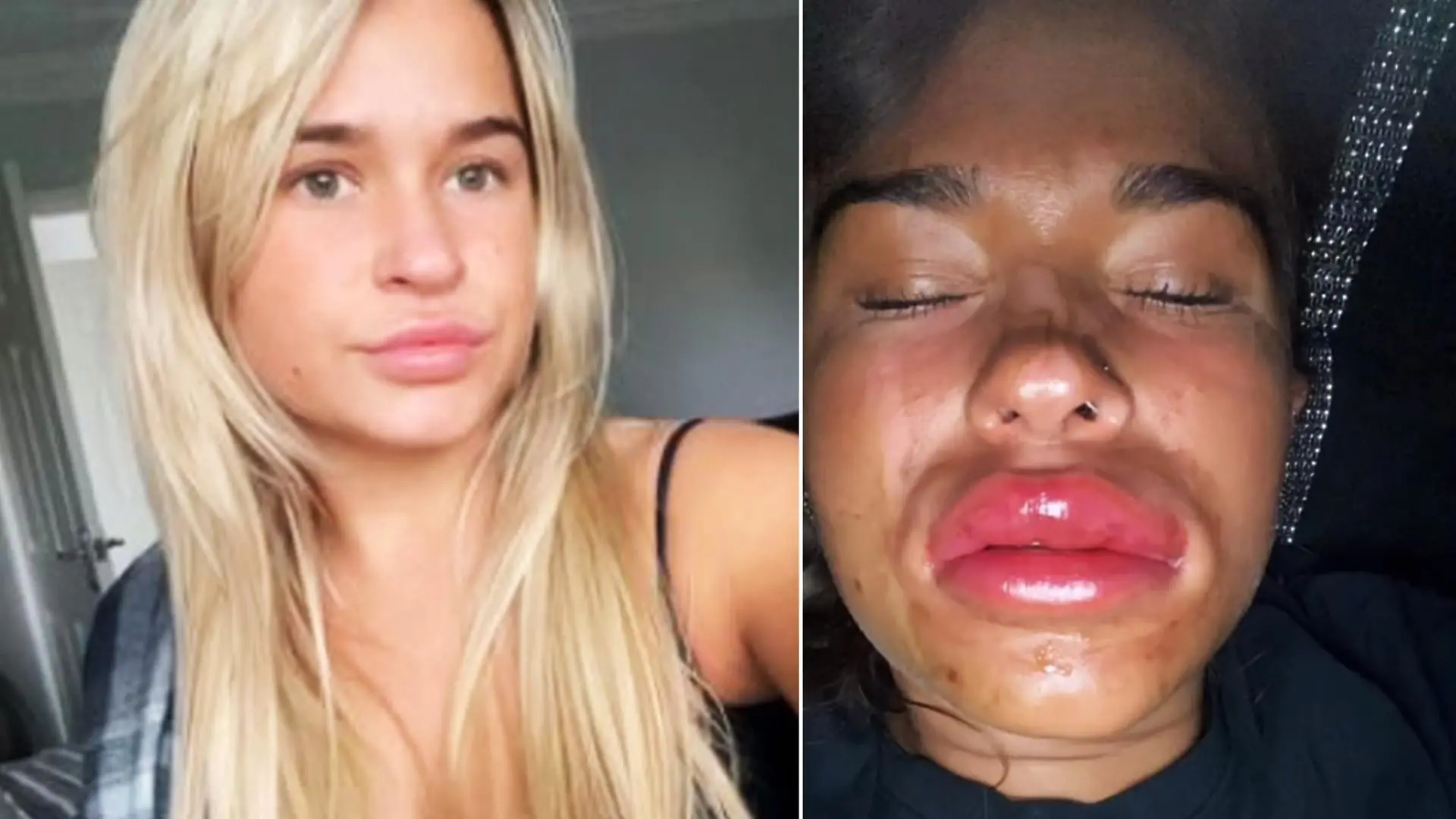 Links sieht man Morgan vor der Injektion und rechts einige Stunden nach dem Lipfilling.