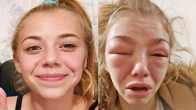 14-Jhrige verliert fast ihr Leben: Allergieschock nach dem  Augenbrauenfrben