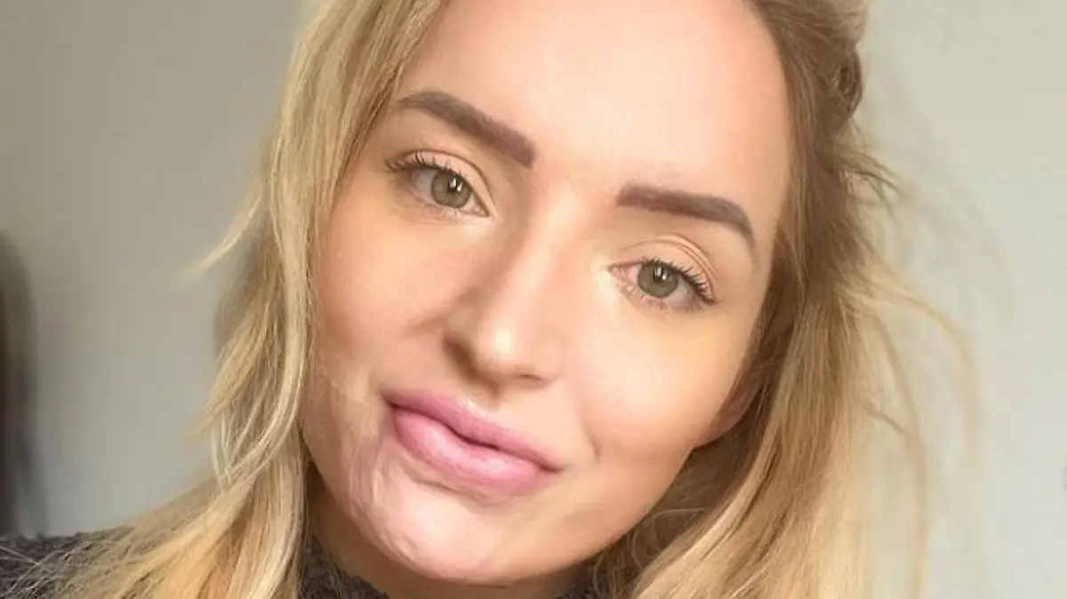 Ashleigh aus Großbritannien mit Narben im Gesicht.