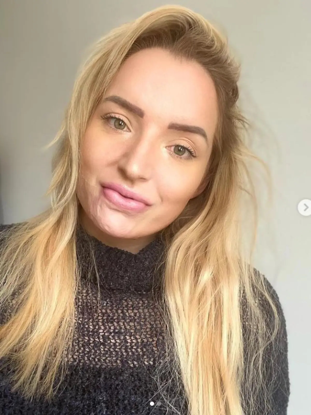 Ashleigh aus Großbritannien mit Narben im Gesicht.