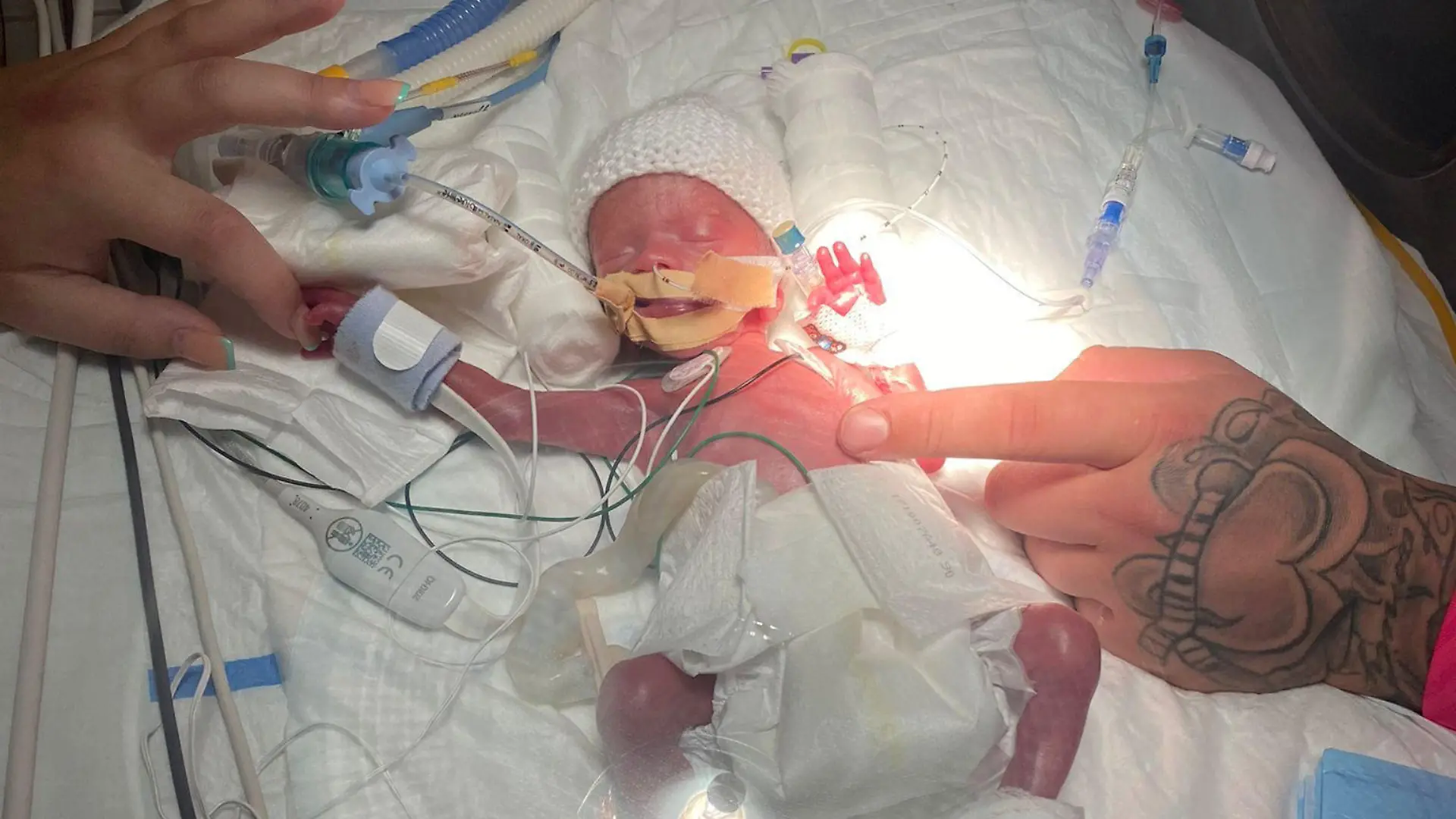 SONDERKONDITIONEN: Satzpreis!
Myles McKenna in hospital. See SWNS story SWSCmyles. A miracle premature baby born the size of an iPhone spent Christmas at home after a "rollercoaster" year where his parents feared he may not survive. Little Myles weighed just 1lb 8oz when he was born 14 weeks premature on June 19. Mum Rebecca Grainger, 24, was rushed into hospital for an emergency Caesarian section after being diagnosed with pre-eclampsia at 26 weeks. Myles was immediately placed on a ventilator as he was unable to breathe for himself and endured a 15-week battle for life. / action press